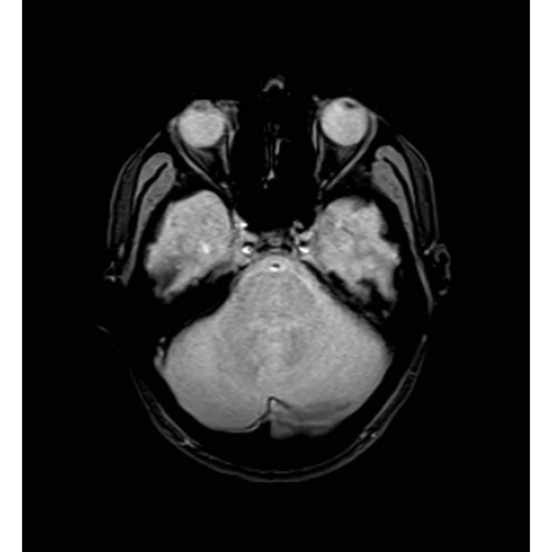播戸竜二さんのインスタグラム写真 - (播戸竜二Instagram)「『スマート脳ドック』 ・ メディカルチェックスタジオ東京銀座クリニックに行きました！ ・ 初めての脳ドック！ 初めての肺のCT！ ・ 脳は問題ナシ👍 ・ 肺も問題ナシ👍 ・ 30分で終わっちゃう！ ・ 41歳には必要やね！ ・ 身体のケアは自分の為に！ ・ ・ #メディカルチェックスタジオ銀座 #脳ドック #肺のCT #問題ナシで安心 #この画像は恥ずかしい #目の手術もあったし #41歳人生の折り返し #いろいろチェックしないとね」11月22日 1時34分 - ryuji_bando