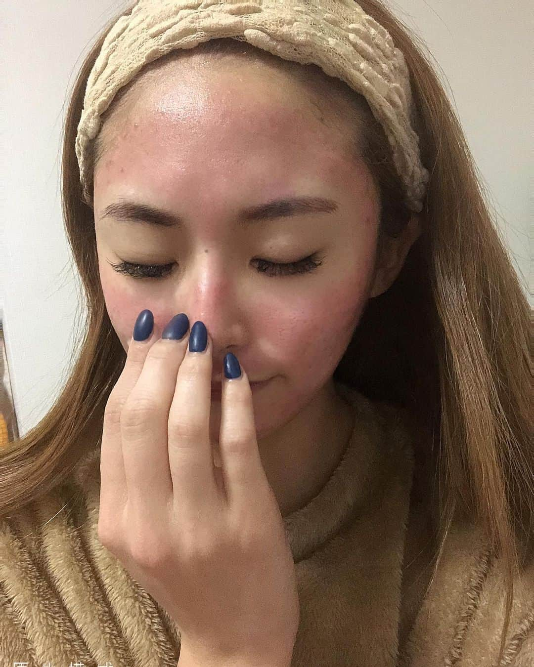 星乃麻梨花さんのインスタグラム写真 - (星乃麻梨花Instagram)「昨日の初体験は ダーマペンという ほっそーい針で肌に穴をあけ 肌再生力を上げる施術を受けてきました😊💓  1日たって化粧で隠れるくらいの赤みになったので 今日からお仕事でますー😍  1週間くらいで傷がなくなりトゥルトゥルになる、、、予定🤣 写真は昨日の施術後です📸  女の子はお金がかかる、、、😱  #星乃麻梨花#桃李#バルセロナ #barcelona  #すすきの #ニュークラブ #キャバ嬢#ホステス #新宿 #歌舞伎町 #六本木 #錦 #中洲 #北新地 #ミナミ #instagram #like4like #l4l #札幌#instagramer#可愛い#谷間#follow4folow #f4f #followforfollowback #likeforfollow #likeforlikes #likeforlikeback #いいね返し」11月23日 18時59分 - marika.0107