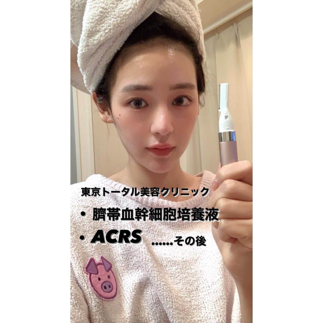 立花陽香さんのインスタグラム写真 - (立花陽香Instagram)「#東京トータル美容クリニック @tokyototalbeautyclinic にて #臍帯血幹細胞培養液 と言う、ヒト型のスーパープラセンタ（へその緒）注射の効果が私にピッタリ合って、栄養が溢れてしまった件。 ⚠️打ち過ぎ注意⚠️ 月に一回で良いかもしれません。私は、こうしてまた再び、再生治療に取り憑かれました。 あの時は栄養失調だった事もあり、とっても弱っていたので、#NMN点滴 と共に久保田院長に提案💉してもらったんだけど、細胞を修復するどころか、色々と元気になり過ぎてしまった😂😂 #ACRS 治療の効果も、まだ続いてます💕 小麦粉を食べちゃってアレルギーが起きても顔だけは守られてるし、謎の肌湿疹が減って快適な日々。あんなに肌が弱くて、いつも泣きついていたのに。  久保田院長、ありがとう🙏🏻  施術時の過去postは #東京トータル美容クリニック ここから探して見てみてね💖💖  寝起きの良さなどは伝えられないけど、分かりやすいのは栄養が溢れてしまった発毛効果について。顔の脱毛、体の再脱毛は赤坂ティファニーのおばちゃん🇰🇷が夜な夜な頑張ってくれます💕 脱毛していた所からは生えて来ないのが不思議💡  もみあげとかどうしよう🤔🤔🤔  #銀座 #美容外科 #美容皮膚科 #皮膚科 #整形 #肌治療 #細胞治療 #臍帯血 #プラセンタ #美肌 #肌 #アンチエイジング」11月23日 19時22分 - haruka_4