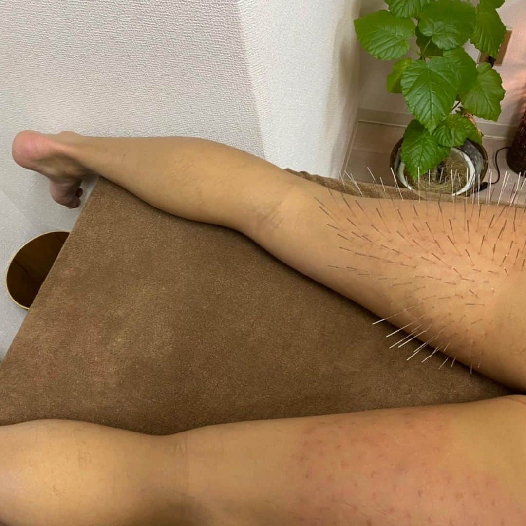 落合知也さんのインスタグラム写真 - (落合知也Instagram)「ルート治療始めました。白川さんにバチバチに打ち込んでもらいました。これからすげー楽しみ！！！ありがとうございました！ そして、ブレックス時代からお世話になりまくってる @ika.kiyo にもまたお世話になりました🙏清さんどこかで恩返しさせてください笑　あざした！！」11月23日 21時13分 - ud_worm91