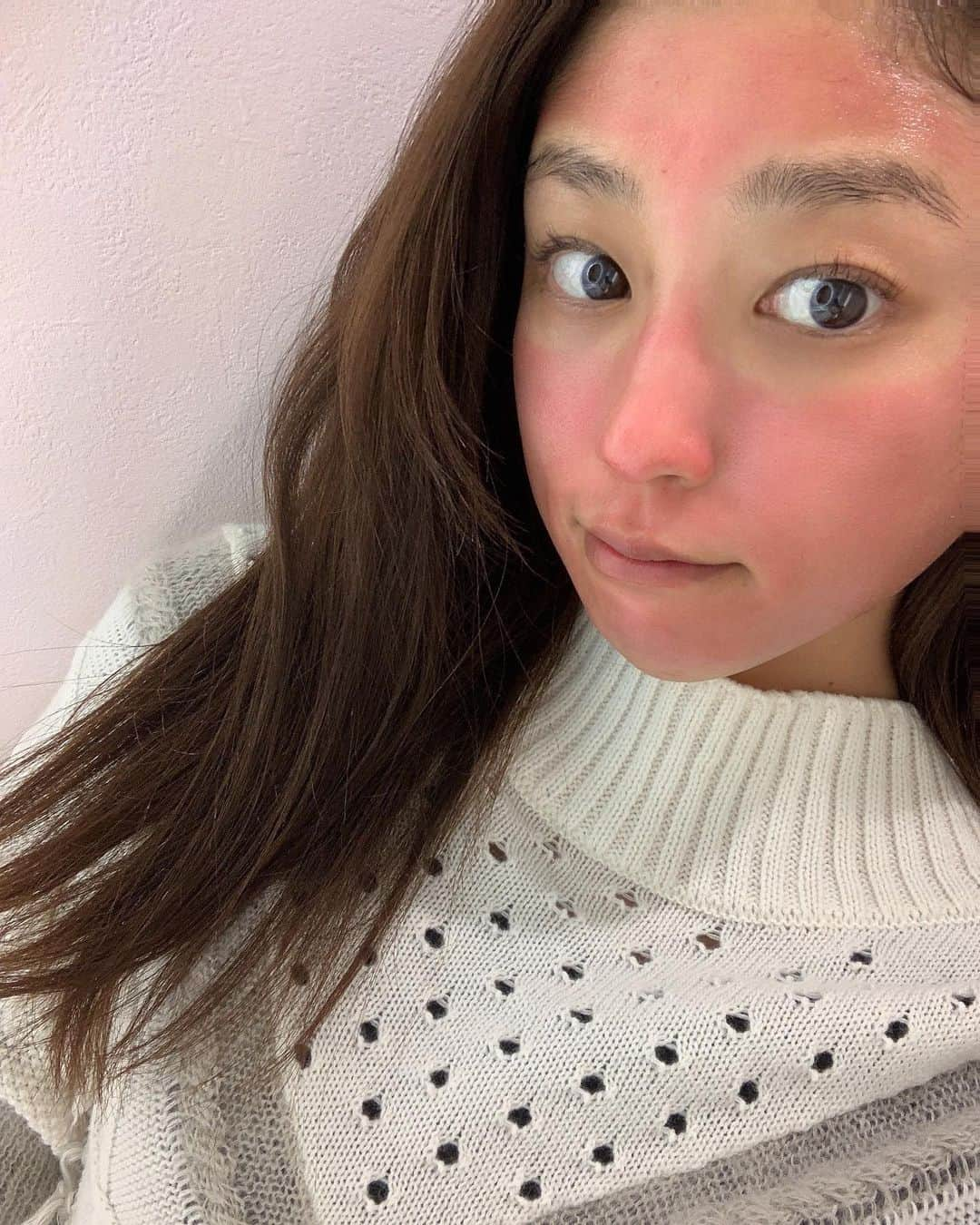 岡副麻希さんのインスタグラム写真 - (岡副麻希Instagram)「.﻿ 人生二度目のダーマペン4🥸💭﻿ （受けた直後の写真） ﻿ やはり日焼け止めとか肌を覆うものは﻿ なるべく塗りたくないから塗らないけど﻿ その分プロに頼ります😂🙏🏽✨ @original_beauty_clinic_ginza ﻿  これからもお世話になります🥺💓💓  痛かったけどそれだけ肌がよくなる〜🥸❣️﻿ がんばれ再生力〜！﻿ ﻿ ずっと居座っていたニキビさんも針をさして﻿ 圧出で出してもらってスッキリ😆﻿ ありがとうございました✨✨ @dr.sato_reiji  ﻿ #赤い#すごい笑﻿ #美容記録#ダーマペン4#美肌﻿ ﻿#ぼさぼさ ﻿」11月23日 22時10分 - maki_okazoe_official