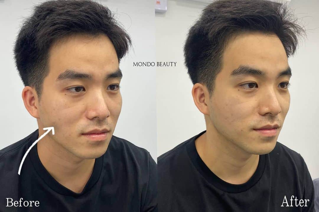 でいぜろバンコクのインスタグラム：「<PR>HIFU mondo beauty   疲れた表情でやすいから3度目のハイフですっきり」