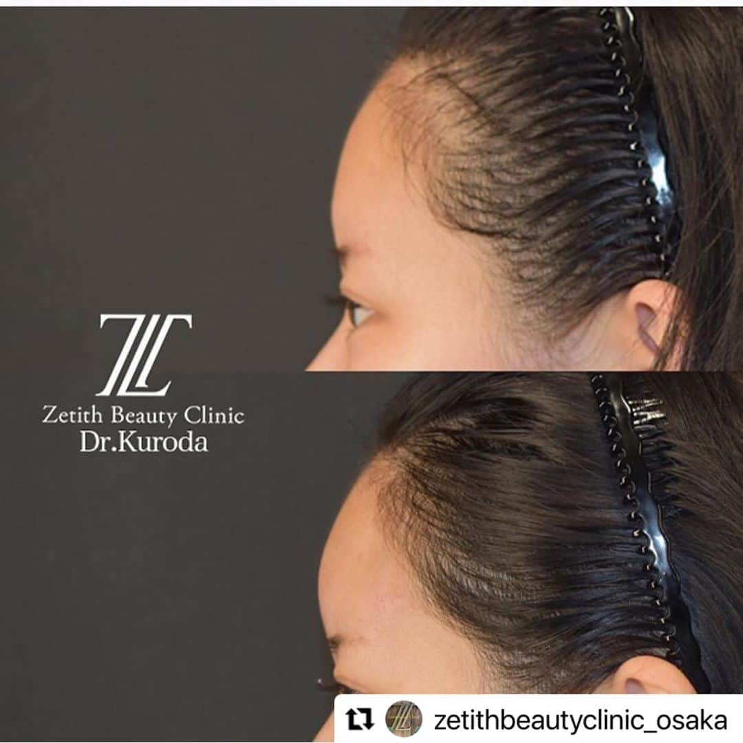 黒田愛美さんのインスタグラム写真 - (黒田愛美Instagram)「#Repost @zetithbeautyclinic_osaka with @make_repost ・・・  皆様こんにちは😃﻿ ﻿ 🌸11月黒田医師キャンペーンのご案内です🌸﻿ ﻿ 11月はヒアルロン酸2本以上で20%OFFでございます💖﻿ ﻿ 今、ヒアルロン酸は使い分ける時代です！﻿ 部位ごとの使い分けを可能にし、自然でなめらかな理想のボリュームへ導きます。﻿ ﻿ お悩みに応じて最適な製剤を用いることにより、効果的な治療を提供致します✨﻿ ﻿ 🌸ボルベラ(アラガン社製)﻿ ライトな柔らかさ。唇などに。 1本1cc ¥100,000-﻿ (+tax) ﻿ 🌸ボリフト(アラガン社製) ﻿ 自然に馴染んで、ほうれい線もふっくらなめらか。 ﻿ 1本1cc ¥100,000-﻿ (+tax) ﻿ 🌸ボリューマ(アラガン社製) ﻿ タフでパワフル。深いへこみに、力強いリフト感。 ﻿ 1本1cc ¥100,000-﻿ (+tax) ﻿ 🌸ボラックス(アラガン社製) ﻿ 粘性が高く、周辺組織との馴染みの良さが注入直後の形成を容易にするため鼻や顎の形成に適しています。﻿ ﻿ 1本1cc ¥120,000-﻿(+tax)  ※黒田医師はアラガンジャパン注入指導医のため、医師施術料としてヒアルロン酸1ccにつき別途¥30,000-(+tax)を頂戴しております。﻿ ﻿ 他にもアンチエイジング治療、目まわり施術、糸リフト、女性器相談、栄養療法なども受け付けております。﻿ ﻿ 黒田医師11月大阪出勤日は26日27日でございます😊﻿ ﻿ 黒田医師大阪院出勤日は毎回大盛況でございます✨﻿ ぜひご予約くださいませ😊﻿ 皆様のご来院をお待ち申し上げております❣️﻿ ﻿ ﻿ 🌟大阪院﻿ 542-0086﻿ 大阪府大阪市中央区﻿ 西心斎橋1-10-40﻿ サンメゾン心斎橋セレブリテ2階﻿ ☎️06-4256-3338﻿ ﻿ ﻿ #zetithbeautyclinic #zetithbeautyclinicosaka  #ゼティスビューティークリニック #ゼティスビューティークリニック大阪心斎橋院 #美容外科 #美容皮膚科 #美容整形  #ヒアルロン酸 #ヒアルロン酸リフト #アラガン社製ヒアルロン酸 #アラガン #ボルベラ #ボリフト #ボリューマ #ボラックス #ハリツヤ  #アンチエイジング  #こめかみのへこみ #頬のこけ #頬の高さ #ぷっくり唇 #丸い額 #シャープな顎 #Vライン #目の下のクマ #ほうれい線 #法令線」11月4日 10時52分 - kurodaaimi