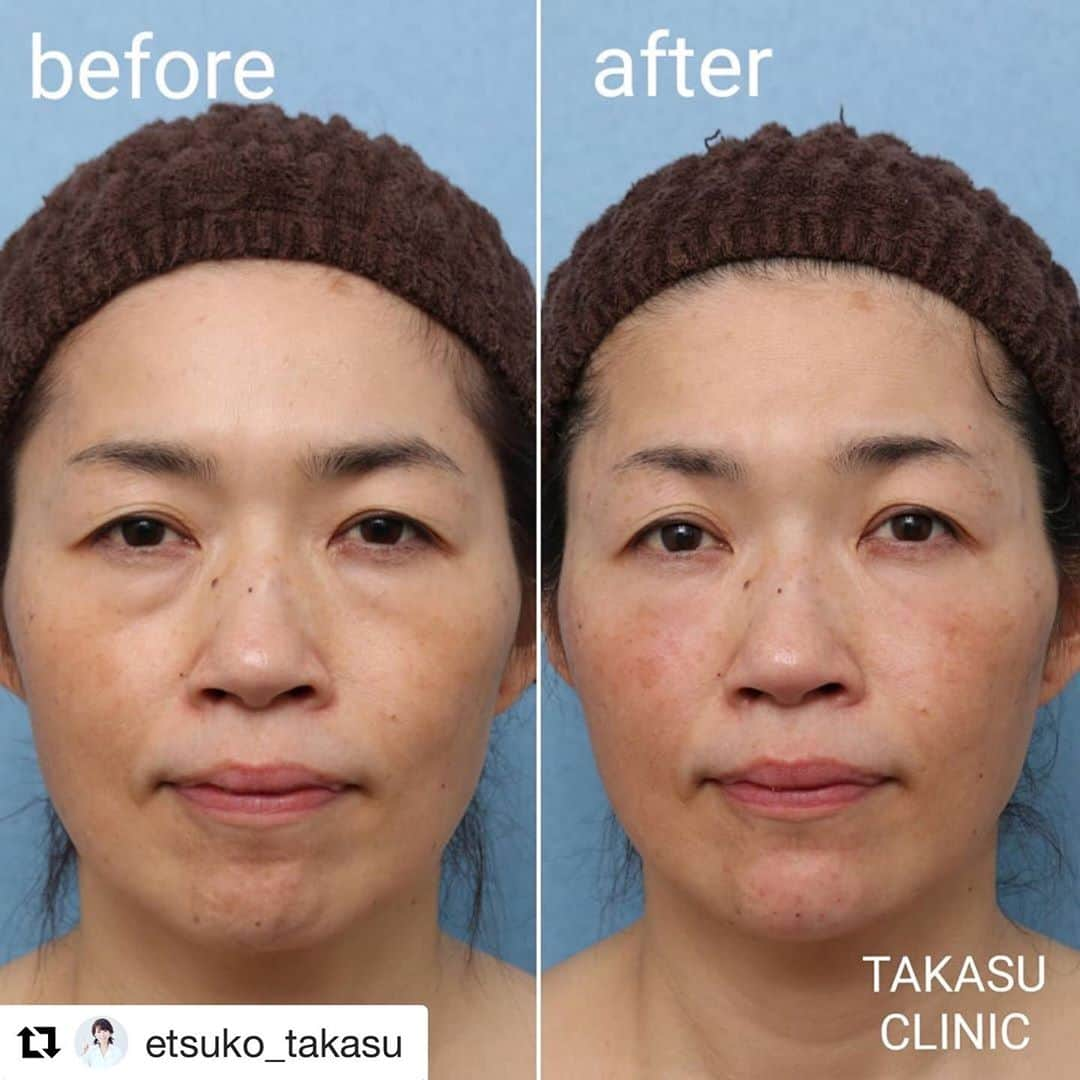 高須クリニック栄院さんのインスタグラム写真 - (高須クリニック栄院Instagram)「#Repost @etsuko_takasu with @get_repost ・・・ 【目の下のタルミ治療】✨ヒアルロン酸注射だけでキレイになります🎵顎のラインを整えると美しくなります✨ ・ 【料金】 ●Vシェイプリフト（ヒアルロン酸注入） 1本：100,000円（税別） ※この方の場合、モニター価格50%OFF ※2020年10月31日現在の値段 ※保険適用外、自由診療 ・ 【リスク・副作用など】 ●内出血（注射針が血管に当たってしまった場合） ●麻酔やヒアルロン酸によるアレルギー症状 ●血管の圧迫による影響 ・ 【ご予約・お問い合わせ】 ⚠️ご予約はお電話にてお願いいたします ⚠️ご予約の際「高須英津子のインスタを見た」と一言お願いいたします ⚠️予約の空き状況確認はお電話のみで受け付けております ---------- 名古屋院☎︎ 052-564-1187（10:00〜19:00） 栄院☎︎ 052-971-6650 （10:00〜19:00） 名古屋院📱 @takasuclinic_nagoya 栄院📱 @takasuclinic_sakae ・ ・ #ヒアルロン酸注射 #高須英津子 #高須クリニック #高須クリニック名古屋院 #高須クリニック栄院 #女医 #美容皮膚科 #切らないたるみ治療 #切らない目の下のたるみ取り #目の下のたるみ #目の下のクマ #filler #fillers #voluma #juvederm #restylane #doctor #cosmeticdermatology #きれいになりたい」11月4日 11時17分 - takasuclinic_sakae