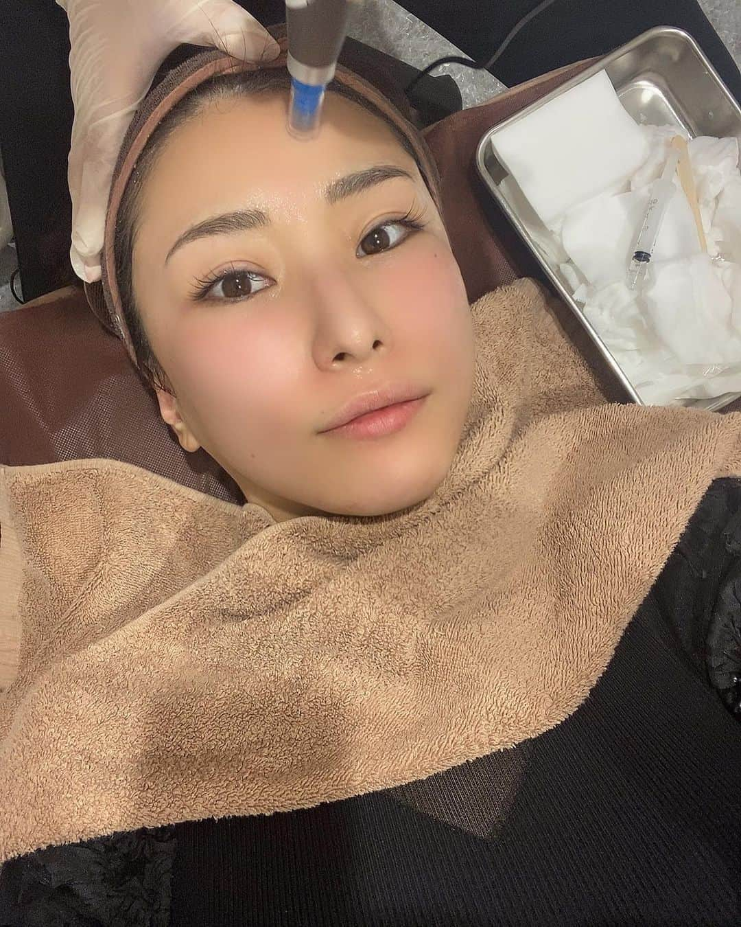 青山千夏さんのインスタグラム写真 - (青山千夏Instagram)「ゼティスビューティークリニック @zetith_beauty_clinic でお肌のメンテナンスをしてきたたよ✌️✨ . 今回受けたのはダーマペン4とエレクトロポレーション💋✨ ダーマペンはお肌に微細な穴を開けて美容成分を入れることでお肌の再生力を高めてくれる施術なんだけど、繰り返すとめちゃくちゃ効果が出るので気に入ってやってる🌹✨ 乾燥しやすくなるのでエレクトロポレーションでイオン導入してもらったよ👩‍❤️‍💋‍👩 . 施術後には成長因子をふんだんに使用したリジェンスキンマスクでクーリング💄✨ いつもの肌よりも美容成分の浸透がいいし、施術後の赤みが引きやすくなるので、これは絶対オススメです🙆‍♂️✨ . 繰り返しダーマペンをやっていたら気になっていたニキビ痕も薄くなってきました🥺💓 毛穴も小さくなったので今後も続けます！ . ゼティスビューティークリニックではオリジナルの基礎化粧品も出していて、特にクリームは幹細胞培養液が配合されているらしくめちゃくちゃ気になってる😌💓 次の時に買ってみようかな🤔 . 院内はモダンで洗練された雰囲気でとても居心地が良かったです🥺 またお肌のメンテナンスの際には伺わせていただきます💓 . . . . . #ゼティスビューティークリニック #ゼティスビューティークリニック大阪心斎橋院 #レーザートーニング #ゼティスビューティー #zetithbeauty #ダーマペン #ダーマペン4 #エレクトロポレーション」11月4日 21時55分 - chinatsu_aoyama0819