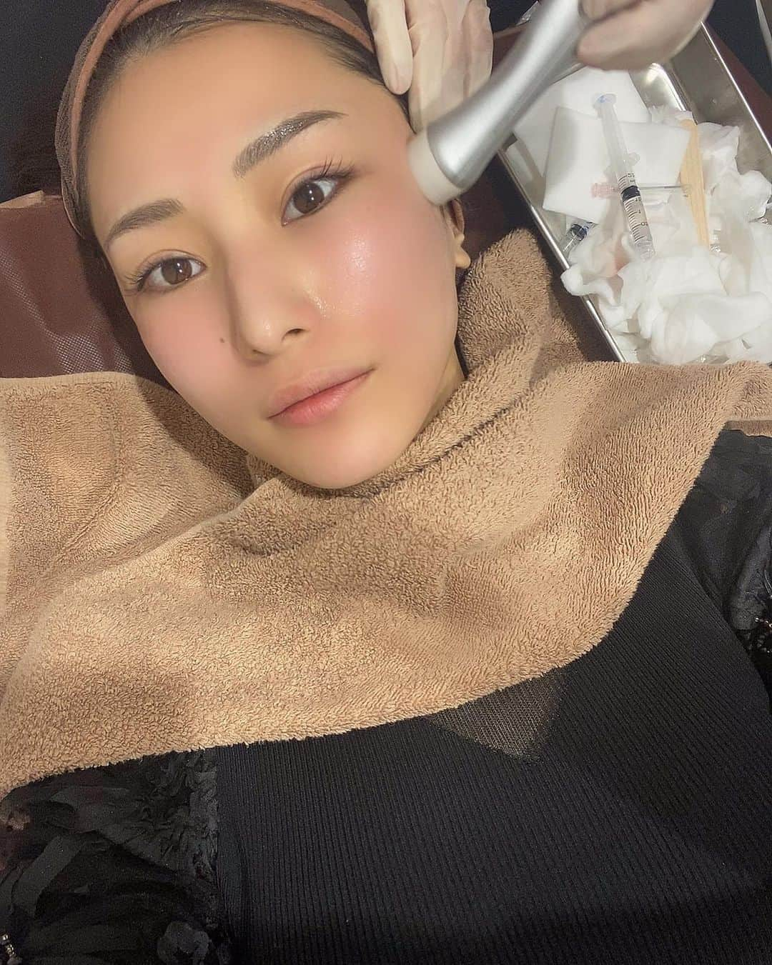 青山千夏さんのインスタグラム写真 - (青山千夏Instagram)「ゼティスビューティークリニック @zetith_beauty_clinic でお肌のメンテナンスをしてきたたよ✌️✨ . 今回受けたのはダーマペン4とエレクトロポレーション💋✨ ダーマペンはお肌に微細な穴を開けて美容成分を入れることでお肌の再生力を高めてくれる施術なんだけど、繰り返すとめちゃくちゃ効果が出るので気に入ってやってる🌹✨ 乾燥しやすくなるのでエレクトロポレーションでイオン導入してもらったよ👩‍❤️‍💋‍👩 . 施術後には成長因子をふんだんに使用したリジェンスキンマスクでクーリング💄✨ いつもの肌よりも美容成分の浸透がいいし、施術後の赤みが引きやすくなるので、これは絶対オススメです🙆‍♂️✨ . 繰り返しダーマペンをやっていたら気になっていたニキビ痕も薄くなってきました🥺💓 毛穴も小さくなったので今後も続けます！ . ゼティスビューティークリニックではオリジナルの基礎化粧品も出していて、特にクリームは幹細胞培養液が配合されているらしくめちゃくちゃ気になってる😌💓 次の時に買ってみようかな🤔 . 院内はモダンで洗練された雰囲気でとても居心地が良かったです🥺 またお肌のメンテナンスの際には伺わせていただきます💓 . . . . . #ゼティスビューティークリニック #ゼティスビューティークリニック大阪心斎橋院 #レーザートーニング #ゼティスビューティー #zetithbeauty #ダーマペン #ダーマペン4 #エレクトロポレーション」11月4日 21時55分 - chinatsu_aoyama0819