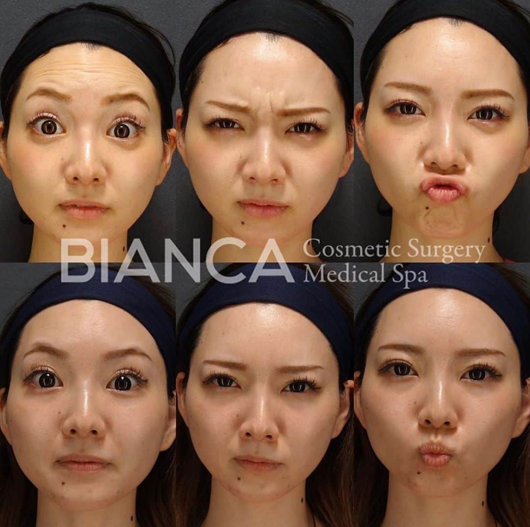 辻沢由有（BIANCA CLNIC 表参道院 院長）さんのインスタグラム写真 - (辻沢由有（BIANCA CLNIC 表参道院 院長）Instagram)「【ボトックスは一気にメンテナンス💉】﻿ ﻿ 気になるシワは一度に治療してあげると、次回のメンテナンスの時期もわかりやすいのでオススメです🥰﻿ ﻿ 上 注入前﻿ 下 注入2週間後﻿ ﻿ ボトックスは、正しい診断と治療が大事👩‍⚕️‼️﻿ ご検討中の方、是非一度カウンセリングに﻿ お越しください😘﻿ ﻿ 🌸額ボトックス💉Botox Vista 8単位.﻿ 🌸眉間ボトックス💉Botox Vista 6単位.﻿ 🌸顎ボトックス💉Botox Vista 10単位.﻿ ﻿ 💴製剤料 600円/単位﻿ 別途 ボトックス施術料 20,000円﻿ ⏳治療時間: 5分﻿ 🗓持続期間: 4〜6ヶ月﻿ 😷腫れ・内出血: 数日程度﻿ ﻿ ﻿ ⚠️ご予約の際は﻿ 『Dr Yuu（辻沢）のインスタ見た』の一言をお願いします👩‍⚕️✨﻿ ﻿ 📍BIANCA CLINIC﻿ ✔︎表参道院﻿ 03-6433-5994﻿ 東京都港区南青山5-11-10  南青山511ビル 2F﻿ ✔︎銀座院﻿ 03-6263-2690 ﻿ 東京都中央区銀座1-5-6 銀座レンガ通り福神ビル 4F﻿ 診療時間 10:00〜19:00﻿ 年中無休（年末年始を除く）﻿  ﻿ ﻿ #美容好き#プチ整形#botoxcapilar #美容好きな人と繋がりたい#美容垢#綺麗になりたい #美容皮膚科 #美容外科 #cosmeticsurgery #plasticsurgery #biancaclinic #ビアンカクリニック #プレ花嫁さんと繋がりたい #followｍe #フォローミー #銀座 #女医 #モニター募集  #dryuuボト#botox #眉間ボトックス #ダイエット #額ボトックス #プチ整形  #イメージチェンジ #ボトックス #ひたいボトックス #女医 #顎ボトックス #目尻ボトックス」11月4日 14時23分 - i_am_yuu__