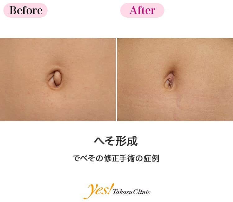 高須クリニックのインスタグラム：「👨🏻‍⚕️高須幹弥医師からのコメント✨⠀ 女子高校生の方です。特にヘルニアなどがあるわけでもなく、左側に結合組織の出っ張りがあるだけのタイプです。手術は単純に出っ張りを切除して縫合するだけです。手術時間は20分くらいです。 施術後2ヶ月が経ち、おへその出っ張りが取れて、だいぶすっきりとしたおへそになりました。これで自信を持ってビキニが着れると思います。 ---------------------------------------------------- 🌈料金✨⠀ ●へそ形成 単純に出ベソを切除縫縮する場合 ¥150,000 / ヘソヘルニアや複雑な手術になる場合 ¥200,000~300,000【東京、横浜、名古屋、大阪】 ---------------------------------------------------- ⚠️リスク・副作用・合併症✨⠀ ●へそ形成 手術後に処方する抗生剤や痛みどめによるアレルギー症状 仕上がりのわずかな左右差（完璧なシンメトリーは不可） 仕上がりが完璧に自分の理想の形にならないことがある 傷跡が肥厚性瘢痕やケロイドになる可能性 --------------------------------------------------- 😊施術についての詳細✨⠀⠀ https://www.takasu.co.jp/photo/navel_08.html ---------------------------------------------------- 📞ご予約・お問い合わせ✨⠀ 0120-5587-10⠀ https://www.takasu.co.jp/cgi-bin/form/contact.cgi ※症例写真や施術に関するご質問なども上記までお願い致します。 ---------------------------------------------------- #へそ形成 #でべそ #でべその修正 #でべその修正手術 #でべそを治したい  #皮膚 #美容 #美肌 #エイジングケア #美容整形 #美容外科 #美容クリニック #美容好き #美容皮膚科 #モニター #モニター募集 #高須クリニック #高須クリニック名古屋 #高須幹弥 #整形したい #プチ整形 #症例 #症例写真 #可愛くなりたい #可愛い #美人」