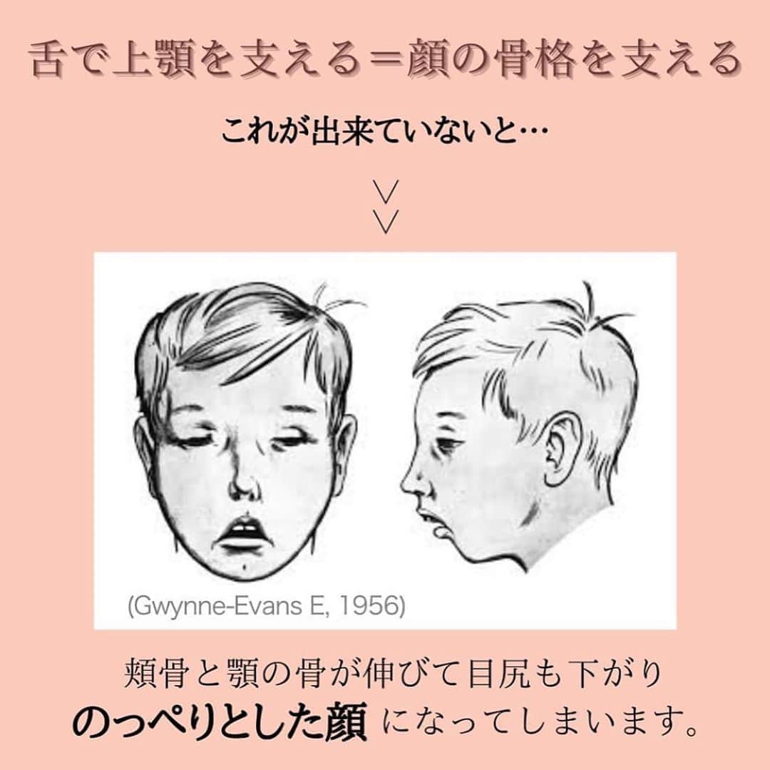 笑顔をリフォームする@健康小顔職人さんのインスタグラム写真 - (笑顔をリフォームする@健康小顔職人Instagram)「． 現在、巷で話題になっている舌の位置で小顔になる⁉️というトピックを @satoko_therapist ちゃんが分かりやすい画像と共に解説をしてくれています！ ． 皆さんの舌の位置はどうですか？改めて意識してみると面白いと思いますよ😆 ． ． #Repost @satoko_therapist with @get_repost ・・・ 【もっと詳しく‼️舌の位置を変えるだけで美人になれるかも？】﻿ ﻿ #舌の位置を正しい位置に変えるだけで美人になれるかも？﻿ ↑﻿ 以前の投稿でかなり反響があったので、﻿ もう少し掘り下げて再投稿させて頂きます！﻿ ﻿ 「骨格は骨で出来ているのに、本当に舌の力だけで全体のバランスが崩れるの？」﻿ と思う方もみえると思います。﻿ ﻿ 顔はいくつもの骨が繋がってできています。﻿ そして骨同士の連結部分は繊維質でできているので時間が経つにつれて少しずつ動いていきます。﻿ ﻿ 上顎骨は顔の大きな範囲を占める重要な部分。﻿ そのため舌の位置を変える事で徐々に骨格が変わる可能性があるのです💀✨﻿ ﻿ 既に海外では「舌の位置を変えようブーム」が起こっています。﻿ この方法は矯正専門医のマイク・ミュー博士の名前に因んで「ミューイング」と呼ばれています。﻿ ﻿ ミューイングを実施した写真をみてみると﻿ 頬骨、顎のライン、鼻の高さなど全体的に立体的な顔に変化していますよね👏﻿ ﻿ これはやはり、若ければ若いほど短期間で変化が現れるそうですが、成人後も顔が変わった事例が沢山あります。﻿ ﻿ 何故なら成人してからも骨の連結部分は完全に固まっていないからです！﻿ ﻿ 私たち(小顔職人 @kogao_shokunin ・小顔美容整体技士 @satoko_therapist )が行う小顔整顔と、﻿ ミューイングを併せて行えば、より早く結果が得られるはずです💆‍♀️✨﻿ ﻿ =============================﻿ ◼︎現役セラピストの私が本気で作った温活アイテム♨️﻿ #nakeda_alphaハーブパット﻿ ▷ @nakeda_alpha 残り僅か⚡️﻿ ﻿ ◼︎ @kogao_shokunin × @nakeda_alphaコラボ﻿ 『エンジェルハーブパット』👼✨﻿ ▷@happy_cosme_kogaoshokunin で好評発売中🌈﻿ =============================﻿ ﻿ #小顔美容整体技士﻿ #セラピスト﻿ #漢方ライフアドバイザー﻿ #ハーブパット作家﻿ #サトコラム﻿ #ミューイング」11月5日 10時08分 - kogao_shokunin