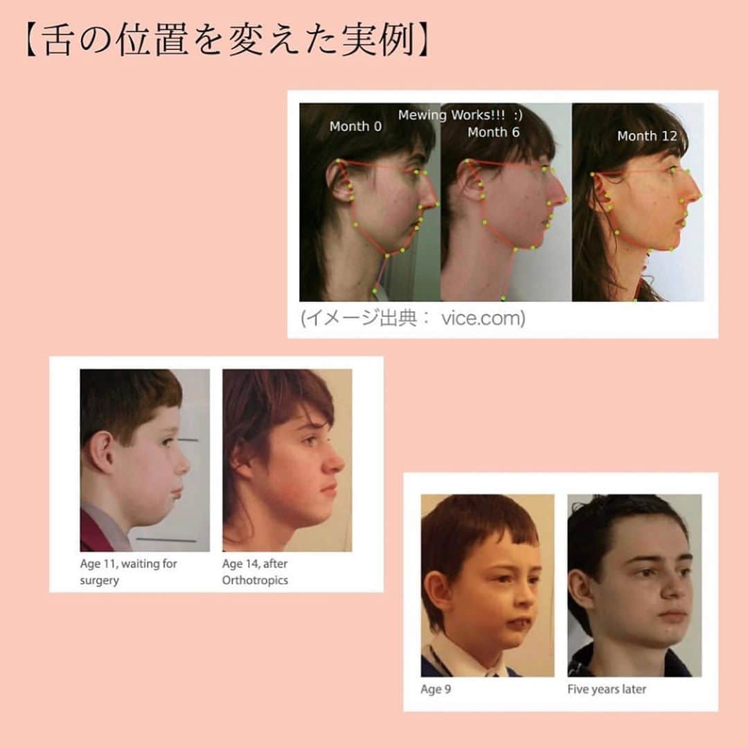 笑顔をリフォームする@健康小顔職人さんのインスタグラム写真 - (笑顔をリフォームする@健康小顔職人Instagram)「． 現在、巷で話題になっている舌の位置で小顔になる⁉️というトピックを @satoko_therapist ちゃんが分かりやすい画像と共に解説をしてくれています！ ． 皆さんの舌の位置はどうですか？改めて意識してみると面白いと思いますよ😆 ． ． #Repost @satoko_therapist with @get_repost ・・・ 【もっと詳しく‼️舌の位置を変えるだけで美人になれるかも？】﻿ ﻿ #舌の位置を正しい位置に変えるだけで美人になれるかも？﻿ ↑﻿ 以前の投稿でかなり反響があったので、﻿ もう少し掘り下げて再投稿させて頂きます！﻿ ﻿ 「骨格は骨で出来ているのに、本当に舌の力だけで全体のバランスが崩れるの？」﻿ と思う方もみえると思います。﻿ ﻿ 顔はいくつもの骨が繋がってできています。﻿ そして骨同士の連結部分は繊維質でできているので時間が経つにつれて少しずつ動いていきます。﻿ ﻿ 上顎骨は顔の大きな範囲を占める重要な部分。﻿ そのため舌の位置を変える事で徐々に骨格が変わる可能性があるのです💀✨﻿ ﻿ 既に海外では「舌の位置を変えようブーム」が起こっています。﻿ この方法は矯正専門医のマイク・ミュー博士の名前に因んで「ミューイング」と呼ばれています。﻿ ﻿ ミューイングを実施した写真をみてみると﻿ 頬骨、顎のライン、鼻の高さなど全体的に立体的な顔に変化していますよね👏﻿ ﻿ これはやはり、若ければ若いほど短期間で変化が現れるそうですが、成人後も顔が変わった事例が沢山あります。﻿ ﻿ 何故なら成人してからも骨の連結部分は完全に固まっていないからです！﻿ ﻿ 私たち(小顔職人 @kogao_shokunin ・小顔美容整体技士 @satoko_therapist )が行う小顔整顔と、﻿ ミューイングを併せて行えば、より早く結果が得られるはずです💆‍♀️✨﻿ ﻿ =============================﻿ ◼︎現役セラピストの私が本気で作った温活アイテム♨️﻿ #nakeda_alphaハーブパット﻿ ▷ @nakeda_alpha 残り僅か⚡️﻿ ﻿ ◼︎ @kogao_shokunin × @nakeda_alphaコラボ﻿ 『エンジェルハーブパット』👼✨﻿ ▷@happy_cosme_kogaoshokunin で好評発売中🌈﻿ =============================﻿ ﻿ #小顔美容整体技士﻿ #セラピスト﻿ #漢方ライフアドバイザー﻿ #ハーブパット作家﻿ #サトコラム﻿ #ミューイング」11月5日 10時08分 - kogao_shokunin