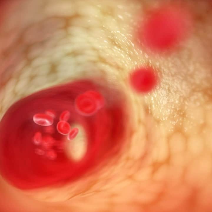 ノバルティスのインスタグラム：「A buildup of cholesterol that forms plaques in our arteries can lead to a condition called atherosclerosis. This disease not only increases our risk of cardiovascular disease, such as heart attacks and stroke, but it is also invisible.   Despite the availability of approved medicines, heart disease remains the number one cause of death by chronic disease worldwide. Lowering LDL cholesterol (or bad cholesterol) levels is challenging--statins are an option, as are healthy lifestyle changes like diet and exercise. Yet, for many, these interventions aren’t enough.   For those with gene mutations that cause extremely high cholesterol, diet and exercise have almost no influence on cholesterol levels. And even for patients without these inherited risks, genetics plays a large role. Doctors may be able to get their patients’ levels lowered, but not always low enough.   Our scientists are working on ways to lower cholesterol by targeting RNA—an approach to medicine that has the potential to stop disease-causing biology at its roots.   Investigational RNA therapies could potentially provide doctors with more options to help people lower their cholesterol and ultimately reduce their risk of heart disease.」