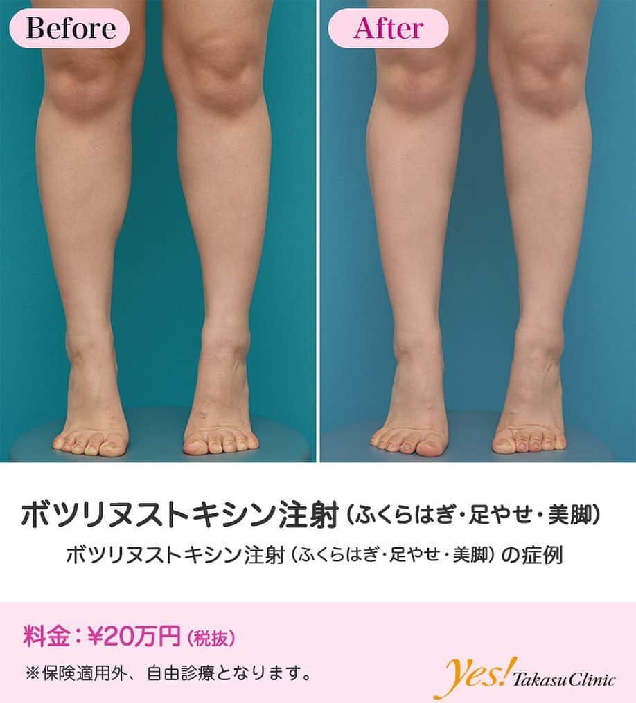 高須クリニックのインスタグラム：「👨🏻‍⚕️高須幹弥医師からのコメント✨⠀ 20代女性の患者様で、ふくらはぎが太いのが悩みでした。 皮下脂肪や浮腫みによるものもありましたが、筋肉によるものが大きかったので、ボツリヌストキシン注射をすることになりました。 注射後は一回り細くなったのがわかると思います。 ふくらはぎの筋肉は、ふくらはぎの後面で横に発達しているので、後から見たときが一番細くなったのがわかりますが、写真で見てわかるように、正面や側面から見ても細くなったのはわかります。 一方、ふくらはぎの皮下脂肪を減らす脂肪吸引やイタリアン・メソシェイプ（イタリアンメソセラピー）・脂肪溶解注射などの治療に関しても、皮下脂肪は筋肉の表面についているので、同じことがいえます。 ---------------------------------------------------- 🌈料金✨⠀ ●ボツリヌストキシン注射（ふくらはぎ・足やせ・美脚） ¥200,000【全院】 ---------------------------------------------------- ⚠️リスク・副作用・合併症✨⠀ ●ボツリヌストキシン注射（ふくらはぎ・足やせ・美脚） 内出血（注射針が血管に当たってしまった場合） 妊活・妊娠・授乳中の方への施術不可 わずかに筋力が弱くなる --------------------------------------------------- 😊施術についての詳細✨⠀⠀ https://www.takasu.co.jp/photo/leg_03a.html ---------------------------------------------------- 📞ご予約・お問い合わせ✨⠀ 0120-5587-10⠀ https://www.takasu.co.jp/cgi-bin/form/contact.cgi ※症例写真や施術に関するご質問なども上記までお願い致します。 ---------------------------------------------------- #ボツリヌストキシン注射 #ふくらはぎ #足やせ #美脚 #ふくらはぎを細くしたい  #皮膚 #美容 #美肌 #エイジングケア #美容整形 #美容外科 #美容クリニック #美容好き #美容皮膚科 #モニター #モニター募集 #高須クリニック #高須クリニック名古屋 #高須幹弥 #整形したい #プチ整形 #症例 #症例写真 #可愛くなりたい #可愛い #美人」