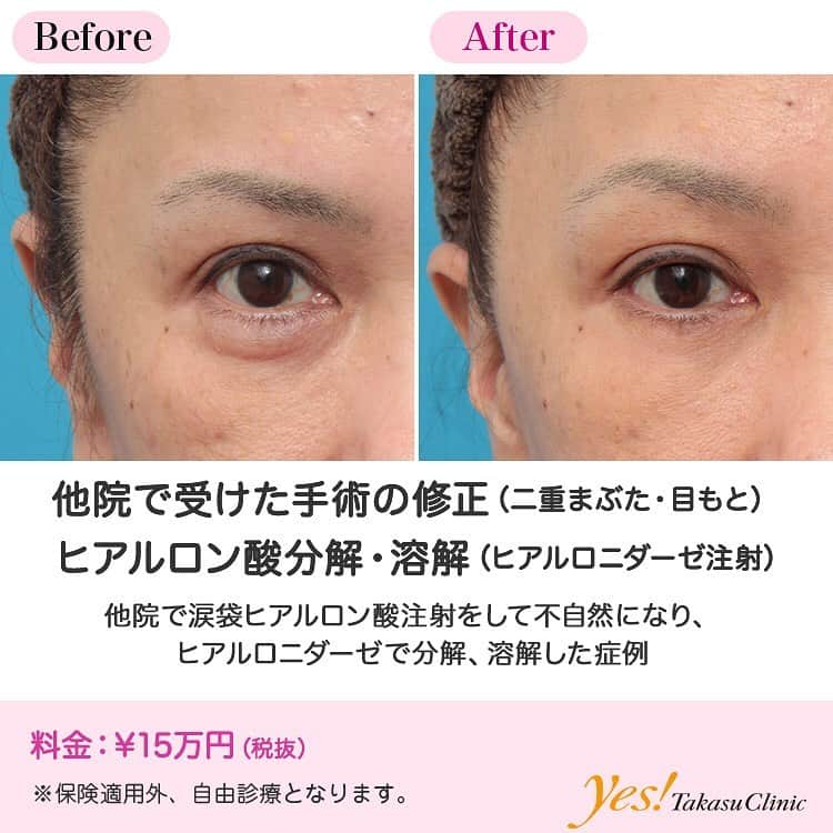 のインスタグラム：「👨🏻‍⚕️高須幹弥医師からのコメント✨⠀ 50代女性の患者様で、他院で涙袋にヒアルロン酸注射をしており、元に戻したいというご要望でした。 診察させていただいたところ、下まぶたの涙袋の部分が不自然に膨らみ過ぎており、涙袋というよりは、目の下のたるみの目袋のようになっていました。 ヒアルロニダーゼを注射し、入っているヒアルロン酸を全て溶かすことになりました。 ヒアルロン酸の入っている部分に、高濃度ヒアルロニダーゼを大量に注入したところ、みるみるヒアルロン酸が分解、溶解、吸収されていき、1週間後に来院されたときには完全に無くなっていました。 涙袋は本来眼輪筋という筋肉のふくらみで、若いときにあるものであり、年を取ると皮膚の張りがなくなって、筋肉が下垂し、なくなっていきます。 そのため、50代で無理して大きな涙袋をヒアルロン酸注射で作ろうとすると、目の下のたるみの目袋のようになってしまい、かえって老けてしまうことがあります。 ---------------------------------------------------- 🌈料金✨⠀ ●ヒアルロン酸分解・溶解（ヒアルロニダーゼ注射） ¥150,000【全院】 ---------------------------------------------------- ⚠️リスク・副作用・合併症✨⠀ ●ヒアルロン酸分解・溶解（ヒアルロニダーゼ注射） 内出血（注射針が血管に当たってしまった場合） アレルギーが生じる可能性 --------------------------------------------------- 😊施術についての詳細✨⠀⠀ https://www.takasu.co.jp/photo/hyaluronjyokyo006.html ---------------------------------------------------- 📞ご予約・お問い合わせ✨⠀ 0120-5587-10⠀ https://www.takasu.co.jp/cgi-bin/form/contact.cgi ※症例写真や施術に関するご質問なども上記までお願い致します。 ---------------------------------------------------- #他院で受けた手術の修正 #ヒアルロン酸分解 #ヒアルロン酸溶解 #ヒアルロニダーゼ注射 #涙袋 #涙袋を元に戻したい  #皮膚 #美容 #美肌 #エイジングケア #美容整形 #美容外科 #美容クリニック #美容好き #美容皮膚科 #モニター #モニター募集 #高須クリニック #高須クリニック名古屋 #高須幹弥 #整形したい #プチ整形 #症例 #症例写真 #可愛くなりたい #可愛い #美人」
