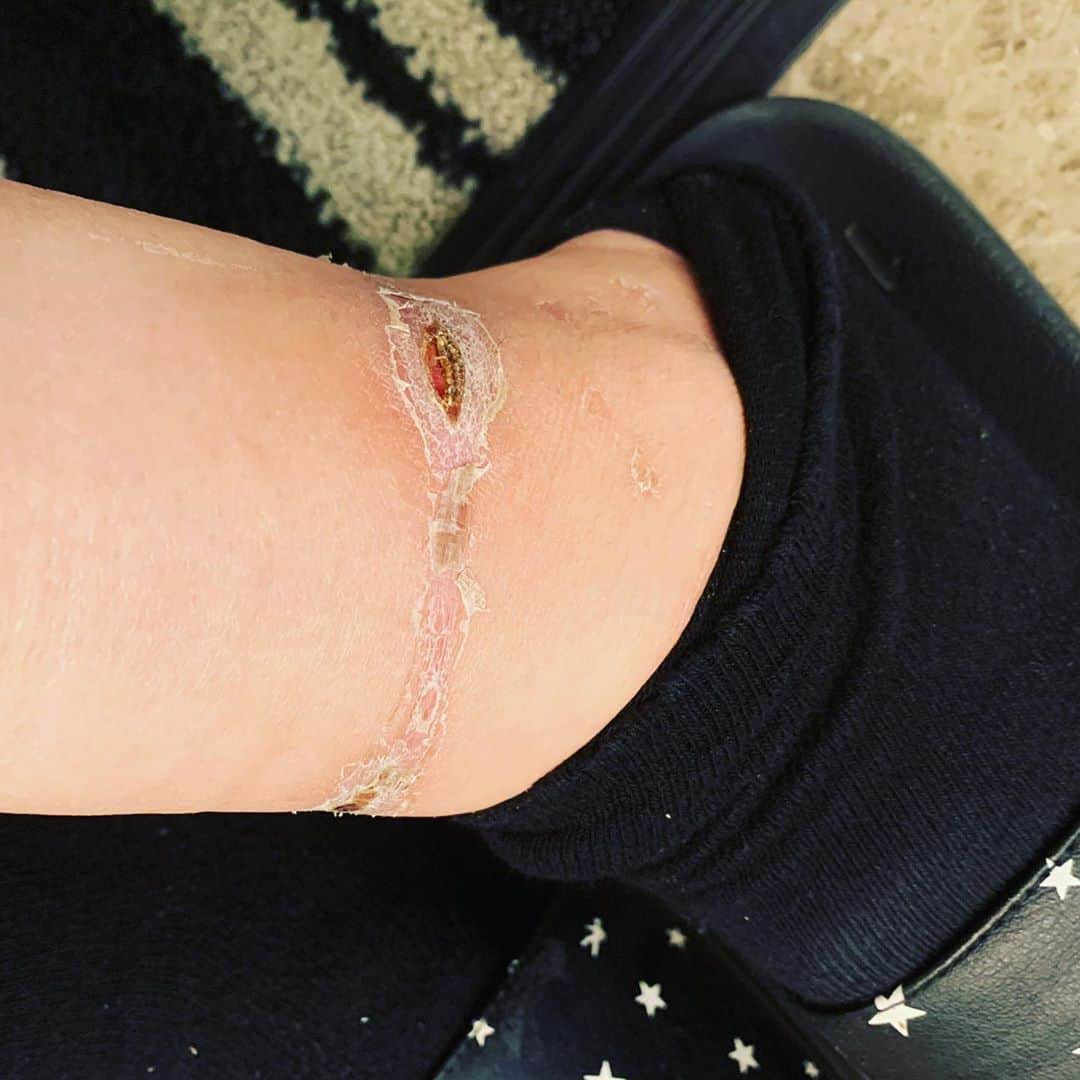 坂口杏里のインスタグラム：「怪我です この足だけじゃなく両手両足、 かんきんですね。 跡が治らないので、 この傷と一生生きていきます。 肋も実はレントゲン撮りました ヒビも入っていました  色々お話したいので、インスタライブ をします。  11:00〜12:00のどこかで配信します。 よろしくお願いします」