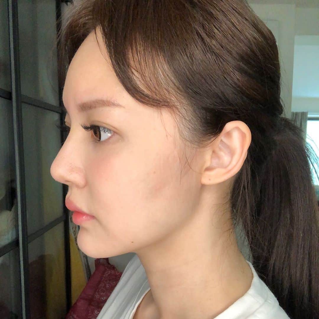 YingTzeさんのインスタグラム写真 - (YingTzeInstagram)「Juvederm Fillers with @sliqclinic Review ! 💆🏻‍♀️ ( this is my very first time taking a photo with my iphone front camera without using beauty app 😂) _ It’s been two weeks since I did my fillers with @drkiroharu . What do you think about my before & after ? 🌝 Can you tell which part I did ? _ Full @juvederm_msia filler review video coming soon ~ stay tuned ! _ #blessed #sliqclinic #juvederm #volux #volite #voluma #volift #facialfillers #fillers #dermalfillers」11月10日 19時58分 - yingtze