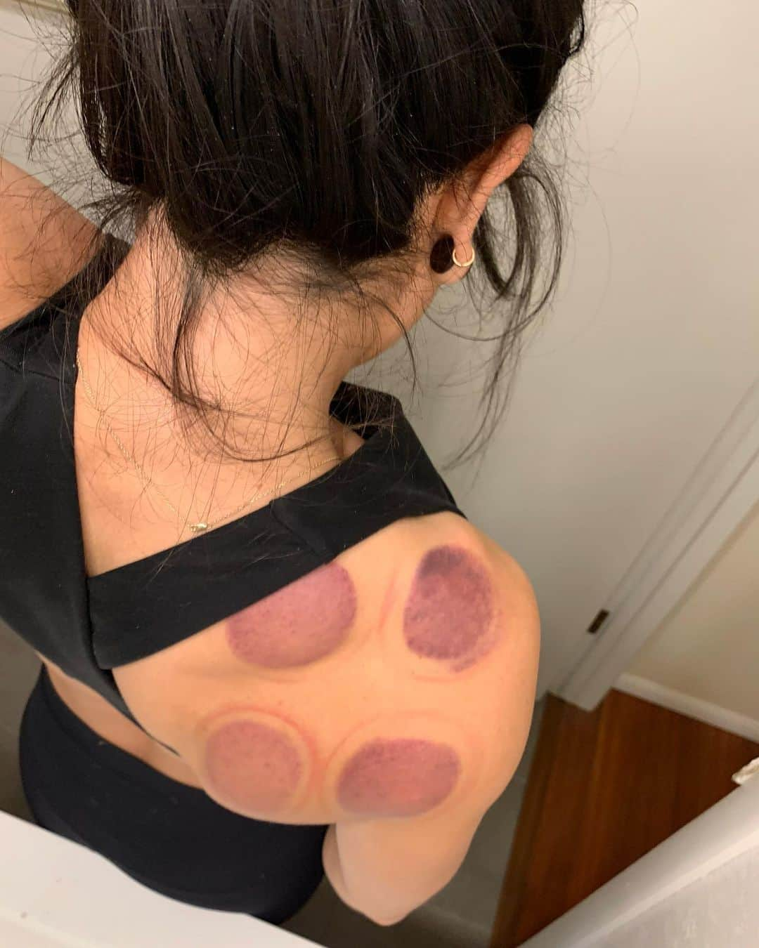 ニーナ・ウィリアムズさんのインスタグラム写真 - (ニーナ・ウィリアムズInstagram)「Two weeks since my shoulder subluxation 📈 I’ve seen good progress by consistently sticking with the rehab my physical therapist and my trainer prescribed. Range of motion is returning and I’m getting scapular and rotator cuff strength back. I can even do some light, easy bouldering! 🤩 . Yesterday, I topped off my rehab with acupuncture and cupping from Scott Turpin @scottthehut, who gave me even MORE rehab and insight into my injury 😁 . I’m all about multiple perspectives and have seen a lot of great wellness practitioners over the years, but I’ve gone back to Scott again and again. He’s helped me through locked wrists, sprained ankles, muscle imbalances from climbing, and now my shoulder. Scott is also an experienced and badass climber himself. Consider this my recommendation for a Chinese medicine practitioner with an understanding of climber anatomy! . Also, Scott has never asked for or expected a promotional trade, which is something I have come to appreciate. He doesn’t even know I’m writing this 🙃 but I wanna support the things I’ve experienced long-term! My current PT and trainer are both great so far, but we are still building that foundation of trust. So thanks @scottthehut for the work you’ve done with me over the years 🙌🏼💪🏼 . #cupping #acupuncture #chinesemedicine #trainingforclimbing #climbingrehab」11月11日 6時31分 - sheneenagins