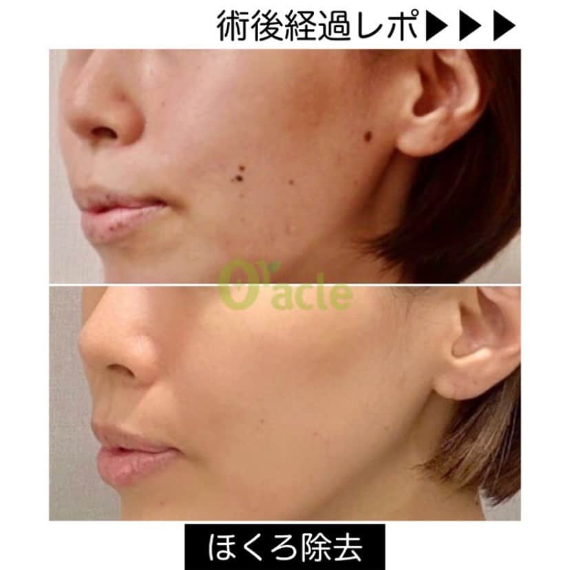 オラクル美容皮膚科東京新宿院さんのインスタグラム写真 - (オラクル美容皮膚科東京新宿院Instagram)「【ホクロ除去】Oracleスタッフレポ📝 治療法:CO2炭酸ガスレーザー  🖋術後レポ 【術後1ヶ月目】 頬のホクロは、うっすら赤い状態で、コンシーラ使用してました。 唇のホクロは回復早くほとんど気にならない状態です。  【術後3ヶ月目】 赤みは消えて、薄い色素沈着のようになっていました。 もともとのホクロが小さいものや色が濃くないホクロは、術後3ヶ月くらいでキレイになりました！ ※もみあげと頬中央の濃いホクロは、肌色になるまではもう少し時間かかりました。  📌気をつけたこと 早くキレイになって欲しかったので、紫外線予防とハイドロキノンはしっかり対策してました  👩‍⚕️CO2炭酸ガスレーザー﻿ ﻿ 【料金】※税抜﻿ ほくろ1つ1回（4㎜以下）　8,000円﻿ ほくろ1つ1回（5㎜以上)	10,000円﻿ ﻿ ※再生テープ（施術した方）　1,500円﻿ ※別途麻酔代がかかります。﻿ ﻿ ⚠️リスクなど﻿ 色素沈着のリスクを避けるため、治療箇所に刺激を与えないように保護テープを貼っていただきます。﻿ 瘡蓋は無理に剥がさないようにしてください。﻿  除去後は紫外線対策をお願いします。﻿ 1度で除去できないものは約3〜6ヶ月の経過をみて2回目を行います。﻿ ﻿ #ほくろ　#ホクロ　#ほくろ除去　#ホクロ除去　#ほくろ取り　#ホクロ取り　#炭酸ガスレーザー」11月11日 9時51分 - oraclejp