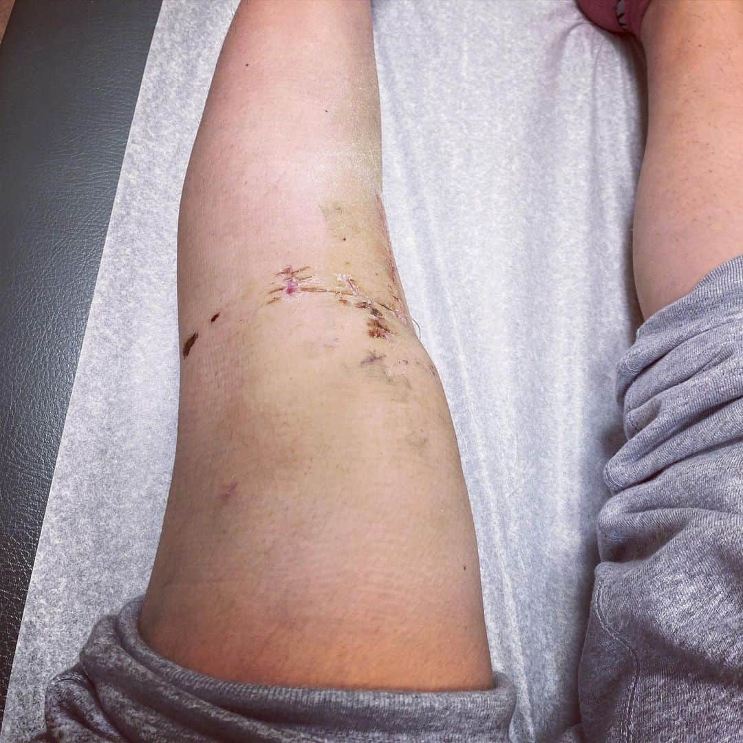 魅津希（井上瑞樹）さんのインスタグラム写真 - (魅津希（井上瑞樹）Instagram)「９月24日 レスリングの練習の際に急に痛みが走りました。その日は歩くのも困難で私の膝も限界がきたと思い、マネージャーと相談してその日に手術を決意しました。元々前十字靱帯損傷しており3年と半年前に手術した左膝ですが、今回その靱帯と別の他の組織が損傷していた為起きた怪我になります。今回前十字靭帯の再建の他、軟骨の切除、変形の調節の計3箇所の手術をしました。9月に怪我をする前からずっと痛みを伴いながらも私が今できる最高パフォーマンスをしてきました。ですが練習でも試合でも万全とはいえないコンディションで行っていたのは事実で、今までそれを公にもしなかったのですが、今回長い休暇をとらさずおえない状況な為みなさんにお伝えする形にしました。試合復帰は1年くらいだと思います。ファンの皆さんには少しお待ちいただく形になりますが、私は私の今できることを精一杯やるのでどうかそれまで待っていてくれたら嬉しいです。  I had an injury my left knee on September 24. Then I couldn’t walk after the training. So I consulted my manager and decided to have surgery. I had a surgery on my left knee October 16th. The contents are repair anterior cruciate ligament of knee with assistance of an endoscope and two other places. I think it will take about a year to return to the fight. I will definitely get stronger and come back, so please wait for me. I’m always thankful for my all coaches, my teammates, my manager, my friends, my family and fans.  #surgery #10.16.2020 #comeback #strongwomen #after #1year #ufc」11月12日 5時30分 - fightermizuki