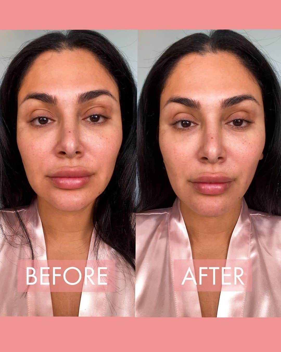 Huda Kattanさんのインスタグラム写真 - (Huda KattanInstagram)「Repost @wishfulskin Before & after just 10 mins of a lymphatic drainage massage!!  Most of the time we don’t realize our faces are holding a lot of fluid that makes us look puffy, older, exhausted & overall unhealthy. Just doing 10 mins of LD massage every morning is so impactful for the overall beauty, health and appearance of our face.  I try to do this every morning using our Get Even Rose Oil because not only do I get great drainage but I also get AMAZING nutrients that help make my face look & feel way healthier 💖💖  I made this oil for myself and the ingredients are absolutely incredible for this process too: 🌹 Damascus Rose Oil helps in clarifying the complexion & soothing the skin 🌸 Rosehip Oil evens the skin tone & reduces the appearance of dark spots 🥕 Carrot Seed Oil moisturizes & tightens the skin Have you tried this facial massage my loves? Would love to hear your thoughts on it too!」11月12日 21時58分 - hudabeauty