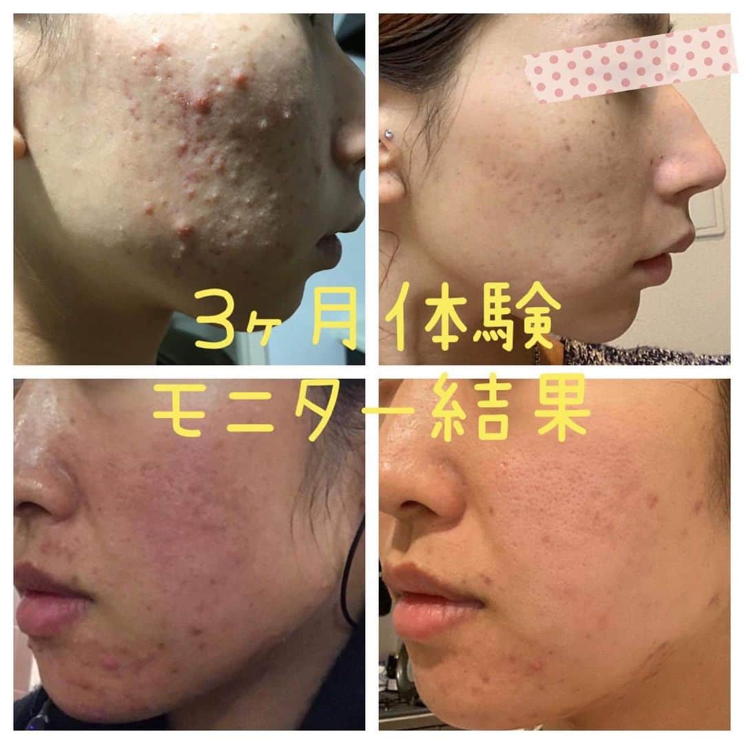 veggy_ambassadorさんのインスタグラム写真 - (veggy_ambassadorInstagram)「新発売❣️ニキビ専用化粧水﻿ モニター募集のお知らせ﻿ ﻿ 美肌菌（皮膚常在菌）を育てて肌フローラのバランスを整えながらニキビの悩みを改善してみませんか？﻿  ﻿ ご興味ある方はアカウントURLよりご応募ください。﻿ ﻿ ①募集期間：2020年11月13日(金)〜12月13日(日)23:59まで﻿ ﻿ ②募集人数：20名﻿ ﻿ ③@hatsuga_recruiting 公募用ページURL下部フォームから応募後、弊社にて審査を行わせて頂きます。﻿ ﻿ ④お顔のニキビでお悩みの18歳〜40歳の女性﻿ （青春ニキビ、大人ニキビでお悩みの方)﻿ ﻿ ⑤商品到着より3ヶ月間﻿ お顔の写真を提出いただける方。﻿ （治療前の写真＋2週間毎に経過報告写真）﻿ ﻿ ⑥モニター期間中﻿ 朝晩の2回しっかりと化粧水をご使用頂ける方。﻿ ﻿ ⑦お顔の写真を症例写真として使用OKな方﻿ (プライバシー保護のため目隠し加工をさせていただきます。症例写真としてブログやSNSに搭載する事をご了承ください。)﻿ ﻿ こんな方のご応募をお待ちしています！﻿ ﻿ 1	クリニックなどの治療では十分に効果の得られなかった方﻿ ﻿ 2	ナチュラルコスメを取り入れながら、肌に優しくニキビを治したい方﻿ ﻿ 3	敏感肌やアトピーで使用出来るスキンケア製品がない方、肌に合うかどうか心配で使用できない方﻿ ﻿ 4	ケミカルなコスメが苦手な方、添加物を避けたい方﻿ ﻿ 【ニキビ専用化粧水体験モニターの特典】﻿ ﻿ 「ニキビ専用化粧水）」（15ml×6本）3ヶ月使用分をご自宅にご郵送いたします。﻿ ﻿ ご不明な点がございましたらアカウントより事務局までメッセージにてお問い合わせください。﻿ ﻿ ニキビ専用化粧水モニター管理事務局﻿ ﻿ 株式会社はつが﻿ info@veggy-life.com﻿ ﻿ #ニキビ﻿ #ニキビケア﻿ #ニキビ専用化粧水﻿ #株式会社はつが﻿ #veggybeauty﻿」11月13日 11時43分 - nadeshiko_official_shop