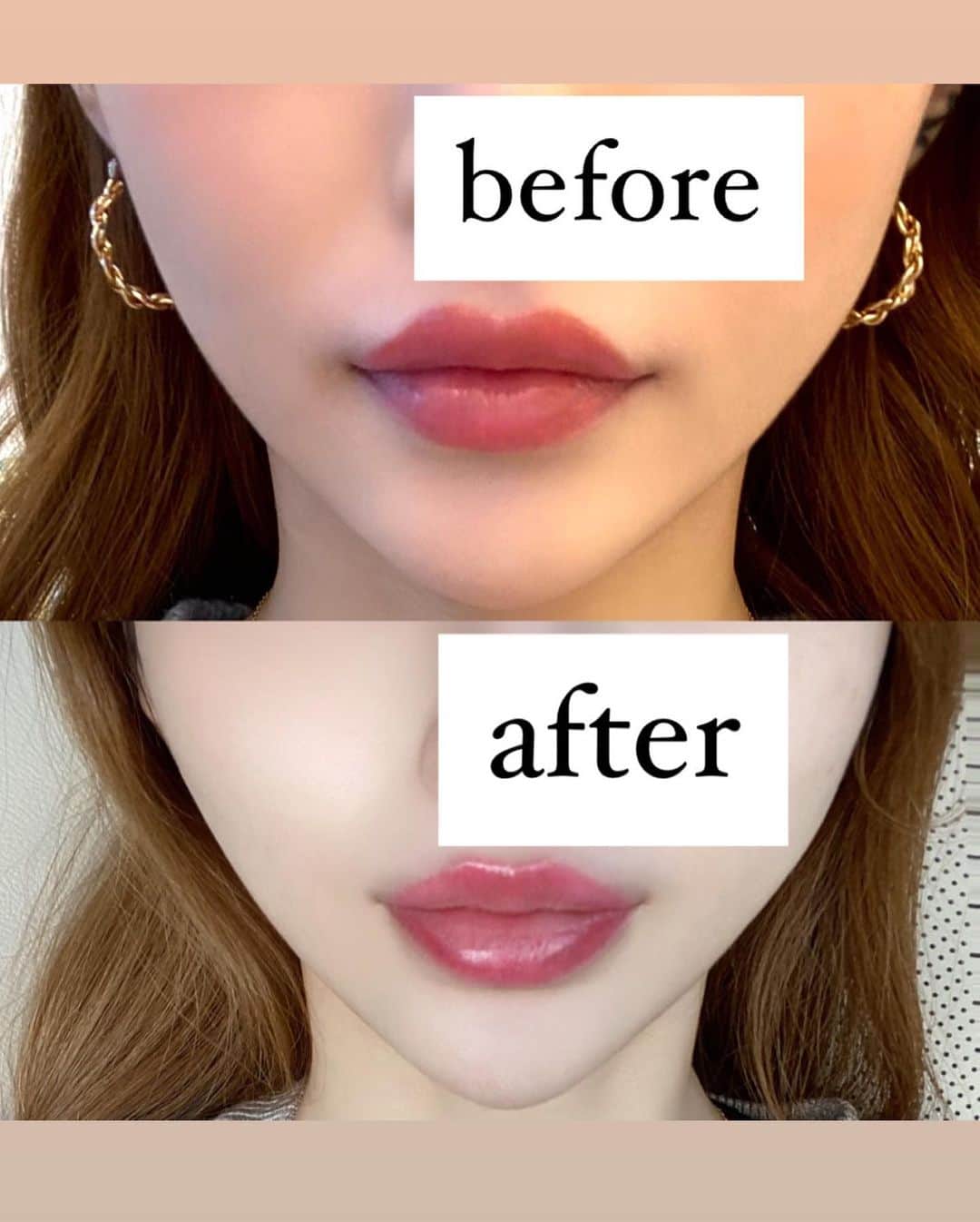ほずにゃむさんのインスタグラム写真 - (ほずにゃむInstagram)「#aclinic で 担当の#山田哲雄 先生 @a_clinic_ginza にAスレッドをしてもらいました✨ . 1年前にも #Aスレッド してて すごく良かったからまたお願いしたよ🥰 たるみが気になってたんだけど 一瞬でリフトアップするし✨ 美肌効果もあるからおすすめだょ💋 . 前にした #シャネル注射 すごい良かったから 2回目お願いしよっと💓💓 . スタッフの皆さんもすごく優しくて安心して施術できました😌 ありがとうございました✨ . #aスレッド #小顔aスレッド #aclinic #aclinic銀座 #aクリニック #エークリニック #美容 #小顔 #美肌 #リフトアップ #美容外科 #美容皮膚科 #美容クリニック」11月13日 14時51分 - hozunyam0818