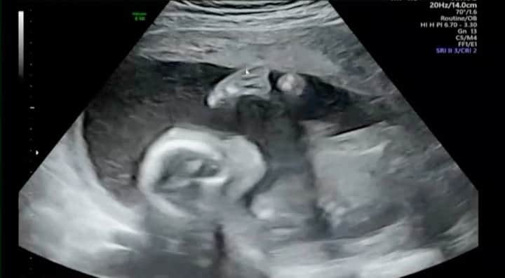 恵里花のインスタグラム：「19週目の時の#エコー動画 にて👶🏻🔊﻿ ﻿ 前屈姿勢になって﻿ 手で足のつま先をタッチしている﻿ レアな姿を収めることができました👣﻿ ﻿ いよいよ7ヶ月目に突入🤰🏻 次はどんな姿をみせてくれるのかな👀💓﻿  #19w2d ﻿#妊婦健診﻿ #マタニティ記録﻿ #公式たまひよグラマー  @tamahiyoinsta」