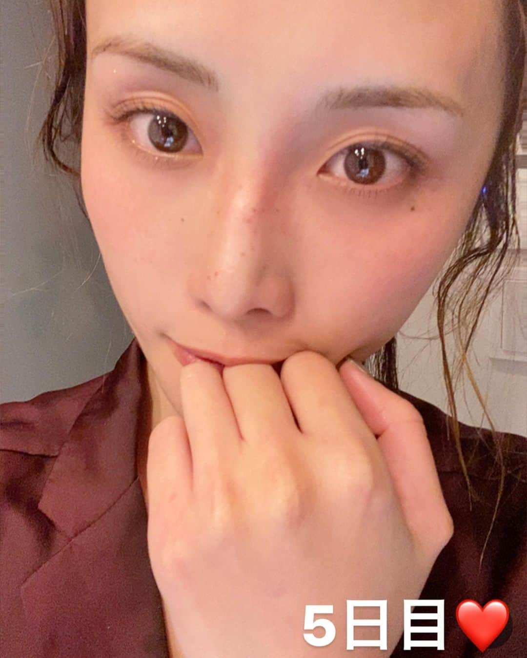 CHIHAさんのインスタグラム写真 - (CHIHAInstagram)「@venus_beautyclinic_ginza で、﻿ ピコスポット受けてきたよ😍‼︎﻿ ﻿ 美容液のおかげで目立つシミはなかったんだけど、ピコスポットってやったことないからずっと気になってたの！﻿ ﻿ 普通カメラ撮影写真もわかりやすく載せたから、よかったらスワイプしてね❤️﻿ ﻿ まずしっかり塗る麻酔をして、薄いシミ含めてスポットで打ってもらいます！全く痛くない！﻿ ただ施術後はちょっとびっくり！﻿ 赤くなり、それからかさぶたになってシミがぽろっと取れるよ😍！﻿ ﻿ 楽しい🤣❤️✨✨﻿ ﻿ 1週間くらいはかさぶたが主張激しい顔面だけど、一応コンシーラーでなんとかなります🌸﻿ ﻿ 6日目から私はノーファンデに戻しました❤️﻿ 最後の動画は施術6日目のノーファンデの動画です！﻿ ﻿ ﻿ ﻿ #ピコスポット　#ビーナスビューティークリニック #venusbeauty #venusbeautyclinic」11月14日 17時58分 - chiha6170