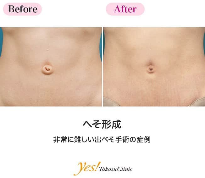 高須クリニックのインスタグラム：「👨🏻‍⚕️高須幹弥医師からのコメント✨⠀ 20代女性の患者様で、出べその治療目的で来院されました。 非常に痩せた体なので、お腹の皮下脂肪がほとんどなく、へその窪みがほとんどありませんでした。 痩せた体で、へその窪みがなく、皮膚が余って盛上がっている出べそは治療が難しく、通常の出べその手術のように、ただ単に余分な皮膚を切除して縫合するだけだと、窪みのない平坦なへそになってしまいます。 手術は局所麻酔下に余分な皮膚を切除して、へその窪みを作るために、皮下にトンネルを作り、その中に皮膚を通し、へその窪みを作りました。 術後は余分な皮膚の盛り上がりが無くなり、へその窪みができました。 痩せた体はお腹の皮下脂肪がないため、へその窪みを作るのが難しいです。 この方は太るとへその窪みの周りに皮下脂肪が付いて土手ができるので、更にへその窪みが深くなって、よりへそらしくなります。 ---------------------------------------------------- 🌈料金✨⠀ ●へそ形成 単純に出ベソを切除縫縮する場合 ¥150,000 / ヘソヘルニアや複雑な手術になる場合 ¥200,000~300,000【東京、横浜、名古屋、大阪】 ---------------------------------------------------- ⚠️リスク・副作用・合併症✨⠀ ●へそ形成 手術後に処方する抗生剤や痛みどめによるアレルギー症状 仕上がりのわずかな左右差（完璧なシンメトリーは不可） 仕上がりが完璧に自分の理想の形にならないことがある 傷跡が肥厚性瘢痕やケロイドになる可能性 --------------------------------------------------- 😊施術についての詳細✨⠀⠀ https://www.takasu.co.jp/photo/navel_09.html ---------------------------------------------------- 📞ご予約・お問い合わせ✨⠀ 0120-5587-10⠀ https://www.takasu.co.jp/cgi-bin/form/contact.cgi ※症例写真や施術に関するご質問なども上記までお願い致します。 ---------------------------------------------------- #へそ形成 #でべそ #でべその修正 #でべその修正手術 #でべそを治したい  #皮膚 #美容 #美肌 #エイジングケア #美容整形 #美容外科 #美容クリニック #美容好き #美容皮膚科 #モニター #モニター募集 #高須クリニック #高須クリニック名古屋 #高須幹弥 #整形したい #プチ整形 #症例 #症例写真 #可愛くなりたい #可愛い #美人」