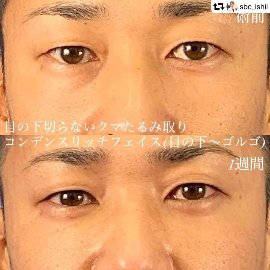 湘南美容外科 柏院さんのインスタグラム写真 - (湘南美容外科 柏院Instagram)「#repost @sbc_ishii ・・・ こんにちは😃 湘南美容クリニック　柏院所属 石井佳央理です👩🏻‍⚕️ . 今回は目の下切らないクマたるみ取り コンデンスリッチフェイス（目の下） 術前・術後１週間のお写真です📸 . クマがあると疲れや老けた印象を与えてしまいますね😢 ビジネスシーンでは第一印象が大事です！😎 男性の方もたくさんご相談をいただいています✨ クマやたるみがなくなるだけで印象が大きく変わりますね😃 . 目の下の切らないクマたるみ取りとは . 加齢や目の疲れにより、 支えきれなくなった眼窩内の脂肪が前に押し出され下まぶたに目袋（たるみ）が形成されます。 目袋による凹凸で影になった部分がクマと呼ばれています。 . まぶたの裏側から膨らみを取り除いてあげるとスッキリした印象になりますよ😃 手術は下まぶたの粘膜からアプローチする為、皮膚の表面には傷跡は残りません👍 . また目元は膨らみと凹みが混在しています。 脂肪を取った後は脂肪注入で凹みを埋めてあげることでより若返り効果がありますよ😉 . 🌸目の下切らないたるみ取り 通常価格 ¥113,000→モニター価格 ¥79,100 . 🌸コンデンスリッチフェイス (目の下) 通常価格 ¥231,000→モニター価格 ¥161,700 (目の下～ゴルゴ） 通常価格￥272,250→モニター価格￥190,570 . ご興味ある方はぜひお気軽にご相談にいらしてくださいね✨ お待ちしております🙇‍♀️ . 【その他現在募集中のモニター】﻿ 🍂美ボディ脂肪吸引(二の腕・肩・頬・アゴ下) 🍂バッカルファット除去 🍂シークレット・プリマリフト 🍂ヒアルロン酸豊胸 🍂婦人科形成術（小陰唇縮小術・副皮除去術） 🍂乳頭縮小術（乳管温存法） 🍂SBCプレミアムソフトプロテーゼ 🍂目頭切開プレミアム . ⭐️湘南美容クリニック柏院⭐️ JR常磐線柏駅 南口より徒歩3分　Day Oneタワー 2階 ☎️0120-489-750 診療時間　10:00～19:00 . #湘南美容クリニック #湘南美容外科 #湘南美容クリニック柏院 #クマ #クマ取り #目の下のクマ #目の下のたるみ取り #目の下の切らないたるみ取り #目の下のクマ解消 #目の下のふくらみ取り #美容外科医石井佳央理 #石井佳央理による若返り #脂肪注入 #コンデンスリッチフェイス #若返り #若返り美容 #アンチエイジング #クマ取りなら湘南石井 #たるみ改善湘南 #マイナス10歳 #男性美容 #エイジングケア湘南#3」11月16日 19時22分 - sbc_kashiwa