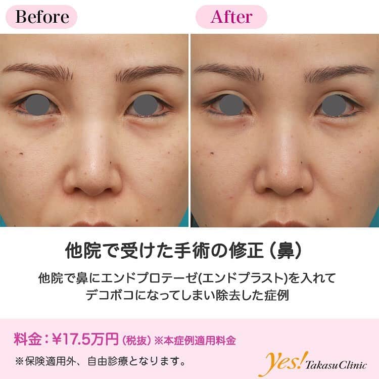 高須クリニックのインスタグラム：「👨🏻‍⚕️高須幹弥医師からのコメント✨⠀ 20代女性の患者様で、他院で鼻にエンドプロテーゼ（エンドプラスト）を入れていました。 鼻根部が不自然に横に広がって、触るとボコボコした感触だったので、除去したいという御要望でした。 手術は局所麻酔を行い、右の鼻の穴の中を数mm切開し、エイヒ（小さいスプーンのような器具）で掻き出しました。 エンドプロテーゼやエンドプラストは、取りたくなったらひとかたまりで簡単に取れるという謳い文句なのですが、実際に取るのは簡単ではありません。 この患者様は、ひとかたまりで取れるどころか、ボロボロと崩れるようにしか取ることができず、時間をかけて少しずつ丁寧に取りました。 その結果、入っていたエンドプロテーゼのほとんどを除去することができました。 エンドプロテーゼ（エンドプラスト）は、注射だけで簡単に永久的な効果をだせるというふれこみで、日本でも一部で出回っていますが、この症例のように凸凹になったり、綺麗な結果にならないことや、除去するのが大変であるなどのリスクが高く、高須クリニックでは扱っておりません。 ---------------------------------------------------- 🌈料金✨⠀ ●他院で受けた手術の修正（鼻） （本症例適用料金） ¥175,000【東京、横浜、名古屋、大阪】 ※診察にてご確認ください ---------------------------------------------------- ⚠️リスク・副作用・合併症✨⠀ ●他院で受けた手術の修正（鼻） 手術後に処方する抗生剤や痛みどめによるアレルギー症状 --------------------------------------------------- 😊施術についての詳細✨⠀⠀ https://www.takasu.co.jp/photo/nose_modify01.html ---------------------------------------------------- 📞ご予約・お問い合わせ✨⠀ 0120-5587-10⠀ https://www.takasu.co.jp/cgi-bin/form/contact.cgi ※症例写真や施術に関するご質問なども上記までお願い致します。 ---------------------------------------------------- #他院で受けた手術の修正 #エンドプロテーゼ除去 #エンドプラスト除去 #鼻修正 #皮膚 #美容 #美肌 #エイジングケア #美容整形 #美容外科 #美容クリニック #美容好き #美容皮膚科 #モニター #モニター募集 #高須クリニック #高須クリニック名古屋 #高須幹弥 #整形したい #プチ整形 #症例 #症例写真 #可愛くなりたい #可愛い #美人」