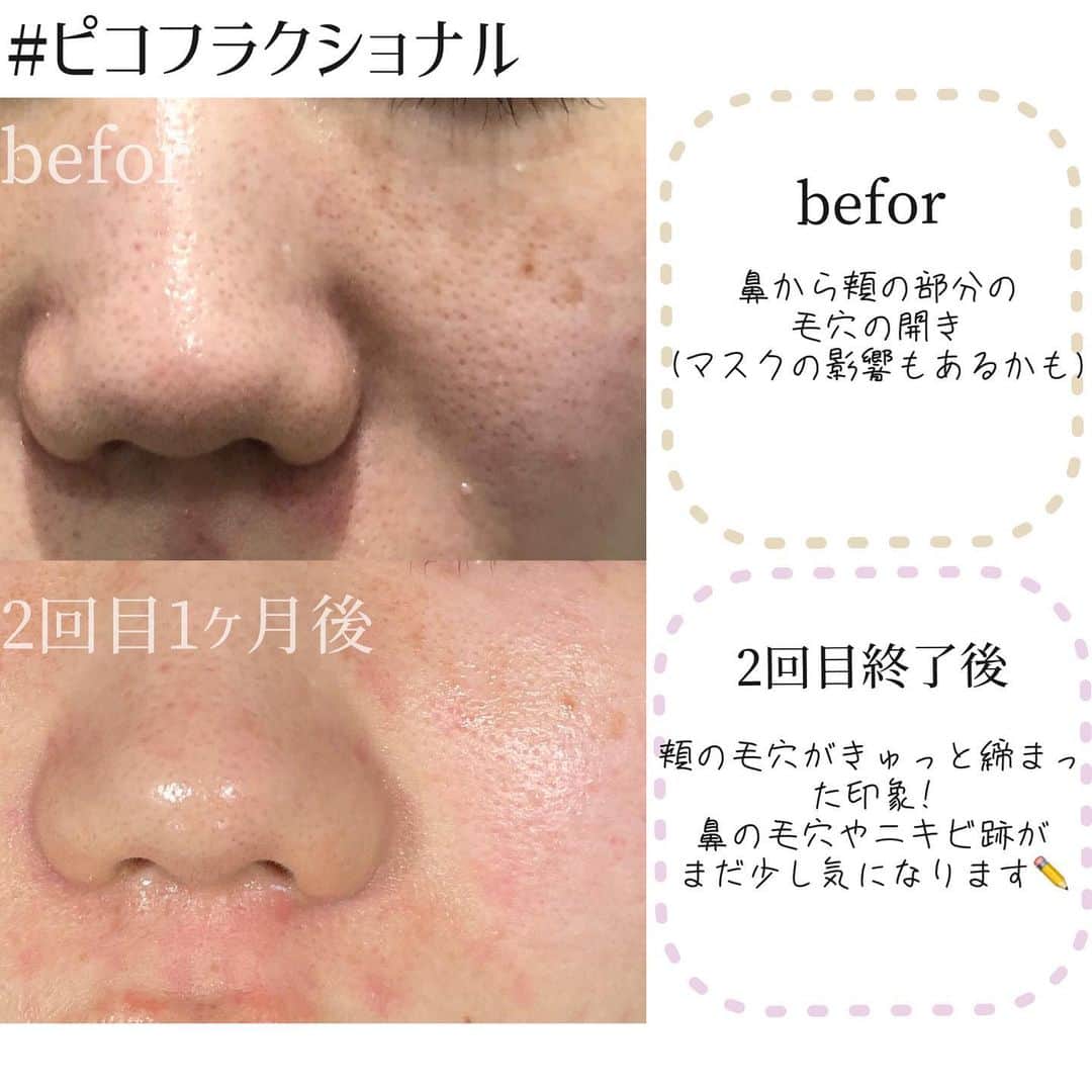 オラクル美容皮膚科東京新宿院さんのインスタグラム写真 - (オラクル美容皮膚科東京新宿院Instagram)「ピコフラクショナル🖋レポート﻿ ﻿ 鼻や頬の毛穴の開きが特に気になるとお悩みの患者様です。﻿ ﻿ 治療名：ピコフラクセル2回﻿ 計5回を予定していて、おうちでのケアも頑張って下さっています😊﻿ ﻿ --------------﻿ ﻿ 気になっていた毛穴の開きが小さくなってきています✨﻿ もともと色白の患者様ですがくすみが取れて透明感が出てきました♪﻿ ﻿ まだニキビ跡や赤みが残っているのでもう少しですね😊﻿ ﻿ 1ヶ月に1回のご来院で徐々に効果が見えてきて﻿ 5回目の施術後が楽しみです💕﻿ ﻿ --------------﻿ ﻿ ﻿ 先日のストーリーアンケートでも﻿ 『毛穴の開き』でお悩みの方が1番多かったです！﻿ ﻿ ピコフラクショナルの特徴は…﻿ フラクセルやダーマペンに比べダウンタイムが軽く、2～3日で赤みやほてりは落ち着きます。﻿ ﻿ ✅ニキビ跡﻿ ✅毛穴の開き﻿ ✅ハリがない﻿ ✅艶がない﻿ ✅小じわ﻿ ✅キメを整える﻿ ✅肌質を改善したい﻿ ﻿ 皮膚の再生力によってコラーゲンを活性化させ﻿ 老化したお肌を入れ替え、新しいお肌に生まれ変わらせます✨﻿ ﻿ 【料金】﻿ 部分1回　7,200円﻿ 全顔1回　19,800円﻿ ﻿ ※麻酔代別途(+2,200円)﻿ ※料金は全て税抜価格です。﻿ ﻿ ﻿ ▪️▫️▪️▫️▪️▫️▪️▫️▪️▫️﻿ ﻿ 🇯🇵オラクル美容皮膚科🇰🇷﻿ 📍東京新宿院﻿ 新宿3丁目19-4 MLJ新宿8階﻿ ﻿ 📍名古屋院﻿ 名古屋市中区錦3丁目24-4﻿ サンシャイン栄5階﻿ ﻿ 【専門】﻿ ニキビ（跡）／毛穴／シミ／しわ／たるみ／痩身／アンチエイジング／美白美肌治療全般／ブライダル相談／メンズ美容﻿ ﻿ 🗝完全予約制﻿ 👠土日祝日も診療﻿ ﻿ 【予約方法】﻿ ☎0120-905-696﻿ ⏰9:00～21:00［年中無休］﻿ ﻿ LINE、メール24時間📧﻿ LINE🆔 @oracle.jp ﻿ 📩HPメールフォームよりお願いいたします﻿ ﻿ ﻿ ▪️▫️▪️▫️▪️▫️▪️▫️▪️▫️﻿ ﻿ ﻿ ﻿ ﻿#オラクル美容皮膚科 #オラクル #oracle #美容皮膚科 #ピコフラクショナル #レーサー #レーザー治療 #毛穴の開き #毛穴 #毛穴ケア #毛穴の黒ずみ #毛穴レス #美容 #美容好き #美容好きな人と繋がりたい #美容垢 #韓国美容 #韓国 #韓国好き #韓国好きな人と繋がりたい #美容オタク #美肌 #ニキビ跡 #ニキビ跡ケア #美白 #肌再生　#オラクル毛穴症例」11月20日 15時00分 - oraclejp