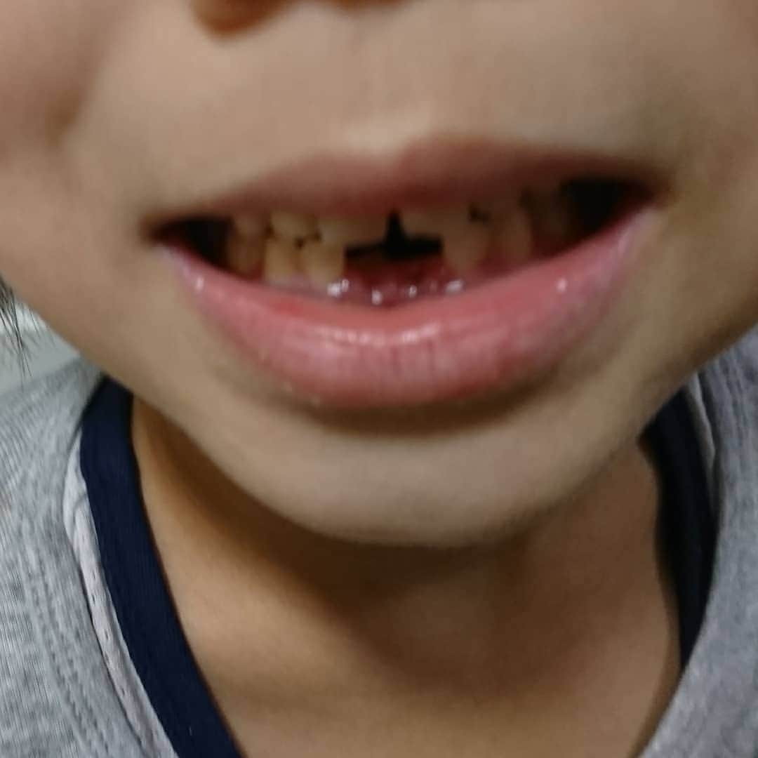 くぼてんきさんのインスタグラム写真 - (くぼてんきInstagram)「前歯が2本ぬけました  #7歳の息子 #前歯 #歯抜け #うどんは歯を閉じたまま食べられます」12月19日 18時58分 - kubotenki