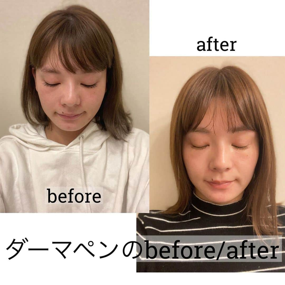 小濱庸子のインスタグラム：「ずっとやってみたかった、 『ダーマペン』を初めて　@zetith_beauty_clinic でやってきた😌 ダーマペンは微小な穴を肌の表面に一瞬で作り出し、穴の形成と同時に美容成分を注入することで、様々な美容効能を直接的に導入する施術‼︎ 特に気になるのは、小鼻横の赤みと顎のニキビ痕だったから、そこを先生に相談した結果、顎と鼻を少し深めに打って、肝斑がある頬は浅く打ちましょうと肌質と悩みに合わせてダーマペンをしてくれた😌✨ 施術後は、鎮静効果のある美容パックをして赤みが早く引くようにケアしたら、ダウンタイムは2日くらいだったかな！すぐに落ち着いた🤔✨ そして、ニキビ跡が目立ちにくくなった🥺すごい！！あと、ニキビの芯があるなってとこも、施術後はなくなってた‼︎続けたら効果があるようなので、またやりたいなって思った🤔🤔🤔 ちなみに、ぬる麻酔をしたので全く痛くなかった✨ #ゼティスビューティークリニック #ゼティスビューティークリニック大阪心斎橋院 #レーザートーニング #ゼティスビューティー #zetithbeauty #ダーマペン #ダーマペン4」