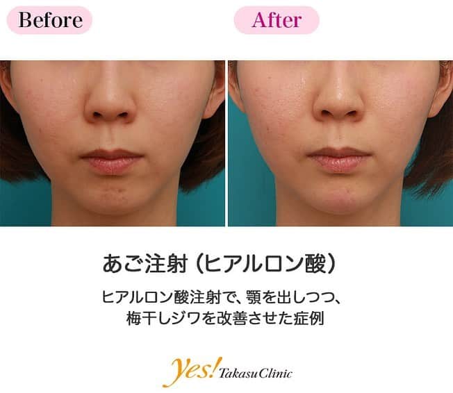高須クリニックのインスタグラム：「👨🏻‍⚕️高須幹弥医師からのコメント✨⠀ 30代女性の患者様で、あまり顎がなく、顎先に梅干しジワができるのを気にされていました。 診察させていただいたところ、やや口元が出ている上に、少し顎が引っ込んでいました。 また、顎に力を入れたり、表情をつくると、顎先に梅干しジワができました。 顎先にヒアルロン酸を注射し、顎を前に出しつつ、梅干しジワを改善させることになりました。 通常の顎を出す専用のヒアルロン酸を1本（1cc）注入しました。 注射後は、引っ込んでいた顎が適度に前に出て、バランスのいい横顔、フェイスラインになりました。 また、顎が前に出たことにより、口元が出ているのが少し目立たなくなりました。 顎のボリュームがでたことにより、顎先にできる梅干しジワも解消し、目立たなくなりました。 今回は1本（1cc）注射しただけなので、顎が出た量はわずかですが、ヒアルロン酸を追加注入すれば、さらに顎を出すことができます。 また、顎先の梅干しジワは、ボツリヌストキシンを注射することにより、さらに改善させることができます。 ---------------------------------------------------- 🌈料金✨⠀ ●あご注射（ヒアルロン酸） ヒアルロン酸 ¥50,000 / 長期持続型ヒアルロン酸注射シャープラインジョウ ¥150,000【全院】 ---------------------------------------------------- ⚠️リスク・副作用・合併症✨⠀ ●あご注射（ヒアルロン酸） 内出血（注射針が血管に当たってしまった場合） 仕上がりのわずかな左右差（完璧なシンメトリーは不可） 仕上がりが完璧に自分の理想の形にならないことがある アレルギーが生じる可能性 注入後の感染 過度にいじったり揉んだりすると腫れる可能性 --------------------------------------------------- 😊施術についての詳細✨⠀⠀ https://www.takasu.co.jp/photo/agochu33.html ---------------------------------------------------- 📞ご予約・お問い合わせ✨⠀ 0120-5587-10⠀ https://www.takasu.co.jp/cgi-bin/form/contact.cgi ※症例写真や施術に関するご質問なども上記までお願い致します。 ---------------------------------------------------- #あご注射 #ヒアルロン酸注射 #顎を出したい #梅干しジワ改善 #バランスのいい横顔  #皮膚 #美容 #美肌 #エイジングケア #美容整形 #美容外科 #美容クリニック #美容好き #美容皮膚科 #モニター #モニター募集 #高須クリニック #高須クリニック名古屋 #高須幹弥 #整形したい #プチ整形 #症例 #症例写真 #可愛くなりたい #可愛い #美人」