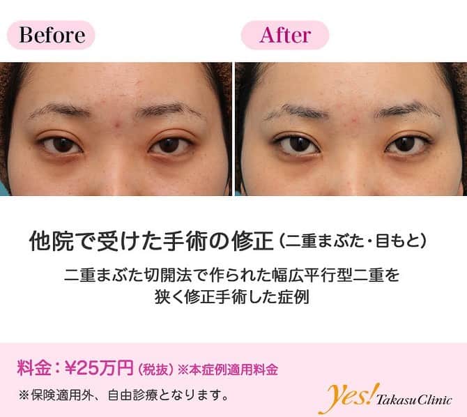 高須クリニックのインスタグラム：「👨🏻‍⚕️高須幹弥医師からのコメント✨⠀ 20代女性の患者様で、約1年前に二重まぶた切開法を受けています。 そのときは幅広平行型二重を希望されていたため、目を閉じた状態で、まつ毛の生え際から約10mmの位置で切開しており、目を開けた状態で幅が広い平行型二重になっていました。 ただ、元々まぶたの皮膚が厚く、特に皮下脂肪が厚いタイプであるため、やや不自然な二重になっていました。 具体的に何が不自然かというと、 ・目を開けた状態で、二重のラインの下の皮膚がぷっくり膨らんでハムのようになり、まつ毛の生え際の上に覆い被さって、まつ毛の生え際が隠れて眠たそうな印象になっていること。 ・幅広い二重を作るためにまぶたの上のほうの厚い部分の皮膚を切開して癒着させているため、目を閉じた状態や伏し目になったときに傷跡の食い込みが不自然に目立つ。 などのことが挙げられます。 患者様は、二重の幅を狭くして、普通に自然な二重に修正したいというご要望だったので、二重の幅を狭くする修正手術をすることになりました。 前回の手術では皮膚を切除されていないので、前回の切開線を二度切りし、それよりまつ毛側の皮膚を最大幅で約3mm切除し、二重のラインを作り直しました。 今回の手術では、眼窩内脂肪やROOFの切除は行っていません。 今回の修正手術を行ったことにより、結果的に、目を開けた状態でまつ毛の生え際から約7mmの位置で切開し、約3mmの幅で皮膚を切除する二重まぶた全切開法を最初から行ったのとほぼ同じ仕上がりになりました。 その結果、目を開けた状態で、二重のラインの下の皮膚がぷっくり膨らんでハムのようになっていたのが改善し、まつ毛の生え際が修正手術前に比べてある程度見えるようになり、眠たそうな印象が改善しました。 また、目を閉じた状態や伏し目になったときに傷跡の食い込みが不自然に目立つのもだいぶ改善し、傷跡がかなり平らに近づきました。 ---------------------------------------------------- 🌈料金✨⠀ ●他院で受けた手術の修正（二重まぶた・目もと） （本症例適用料金） ¥250,000【東京、横浜、名古屋、大阪】 ※診察にてご確認ください ---------------------------------------------------- ⚠️リスク・副作用・合併症✨⠀ ●二重まぶた・全切開法 まぶたの強い腫れ（術後／個人差があります） 内出血（術後） 仕上がりの左右差（片目ずつ手術をする場合） 不自然な二重（無理に二重の幅を広げた場合） 仕上がりのわずかな左右差（完璧なシンメトリーは不可） 仕上がりが完璧に自分の理想の形にならないことがある 二重のラインの癒着がとれる可能性 手術後の血腫 --------------------------------------------------- 😊施術についての詳細✨⠀⠀ https://www.takasu.co.jp/photo/eye_modify022.html ---------------------------------------------------- 📞ご予約・お問い合わせ✨⠀ 0120-5587-10⠀ https://www.takasu.co.jp/cgi-bin/form/contact.cgi ※症例写真や施術に関するご質問なども上記までお願い致します。 ---------------------------------------------------- #他院で受けた手術の修正 #二重修正 #二重の幅を狭くしたい #自然な二重  #皮膚 #美容 #美肌 #エイジングケア #美容整形 #美容外科 #美容クリニック #美容好き #美容皮膚科 #モニター #モニター募集 #高須クリニック #高須クリニック名古屋 #高須幹弥 #整形したい #プチ整形 #症例 #症例写真 #可愛くなりたい #可愛い #美人」