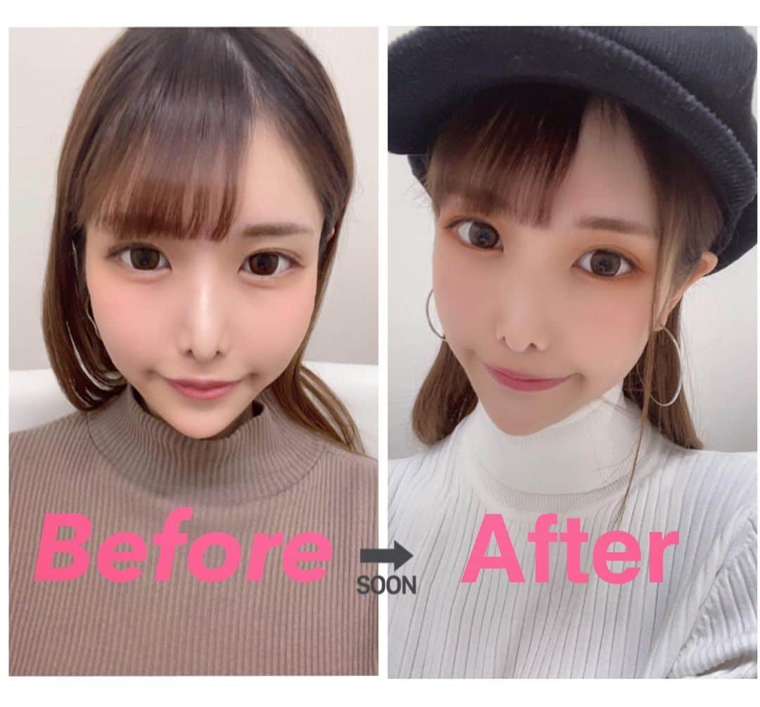 AIRIのインスタグラム：「#TCB式小顔美肌再生　1ヶ月経過😘  Before→Afterの写真で自分でも変わっててびっくり👼 すっきりして気分もあがるから自分磨きっていいね◎  東京中央美容外科池袋西口院  @tcb_ikebukuronishiguchi  さんしっかりリフトアップしたい方オススメ🥰  佐藤先生(@tcb_satodai) 学会発表や整形手術の本も出しているすごい先生👏間違いない◎  #TCB式小顔美肌再生 #リフトアップならTCB東京中央美容外科 #東京中央美容外科池袋西口院#東京中央美容外科#美容外科#佐藤大介#池袋西口#小顔美肌再生#美容整形ならTCB東京中央美容外科#リフトアップ#池袋#小顔#たるみ#美容#美意識高い人と繋がりたい#PR」