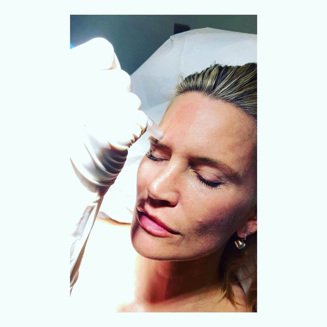 ナターシャ・ヘンストリッジさんのインスタグラム写真 - (ナターシャ・ヘンストリッジInstagram)「My favorite skin pick me up after all the summer fun is micro needling, minimum downtime and stimulates collagen also helps with fine lines etc... and it’s painless! favorite place to get it done @beautechcosmeticcenter with @nurseang_la !!!」12月17日 5時12分 - natashahenstridge