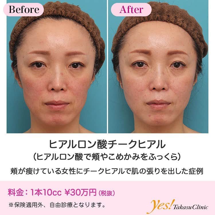 高須クリニックのインスタグラム：「👨🏻‍⚕️高須幹弥医師からのコメント✨⠀ 40代女性の患者で、頬が痩けて、窶れているのが悩みで来院されました。 診察させていただいたところ、体型的にも全身が痩せており、顔にも皮下脂肪があまり付いていない顔貌をしてらっしゃいました。 頬が痩けていることにより、頬骨の下が窪んで陰ができており、実年齢より老けた印象になっていました。 年齢相応に顔のたるみもあったため、たるみ治療の適応もありましたが、頬が痩けていることが最も老けて見られる要因だと思われました。 頬やこめかみの深い窪みを膨らませる専用のヒアルロン酸チークヒアルを頬に注入することになりました。 左右の頬の窪みが深い部分を中心に、5ccずつ計10cc注入しました。 注射後は頬に適度の膨らみができ、窶れている印象がなくなりました。 今後、ほうれい線や目の下の窪みにその部位専用のヒアルロン酸を注射すると更に効果的です。 ---------------------------------------------------- 🌈料金✨⠀ ●ヒアルロン酸チークヒアル（ヒアルロン酸で頬やこめかみをふっくら） 1本10cc ¥300,000【全院】 ※ほとんどの場合、1本で十分ですが、凄く痩せていて、たくさん注入する必要がある人は、まれに2本注入することもあります。 ---------------------------------------------------- ⚠️リスク・副作用・合併症✨⠀ ●ヒアルロン酸チークヒアル（ヒアルロン酸で頬やこめかみをふっくら） 内出血（注射針が血管に当たってしまった場合） 仕上がりのわずかな左右差（完璧なシンメトリーは不可） アレルギーが生じる可能性 注入後の感染 血流不全、皮膚壊死 過度にいじったり揉んだりすると腫れる可能性 --------------------------------------------------- 😊施術についての詳細✨⠀⠀ https://www.takasu.co.jp/photo/cheek001.html ---------------------------------------------------- 📞ご予約・お問い合わせ✨⠀ 0120-5587-10⠀ https://www.takasu.co.jp/cgi-bin/form/contact.cgi ※症例写真や施術に関するご質問なども上記までお願い致します。 ---------------------------------------------------- #ヒアルロン酸チークヒアル #ヒアルロン酸で頬やこめかみをふっくら #チークヒアル #肌の張りを出したい #ふっくらした頬 #頬をふっくらさせたい  #皮膚 #美容 #美肌 #エイジングケア #美容整形 #美容外科 #美容クリニック #美容好き #美容皮膚科 #モニター #モニター募集 #高須クリニック #高須クリニック名古屋 #高須幹弥 #整形したい #プチ整形 #症例 #症例写真 #可愛くなりたい #可愛い #美人」