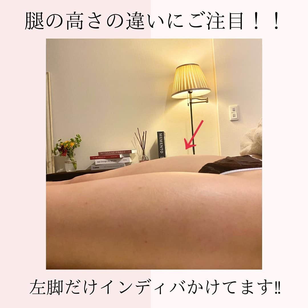 Eternal Total Beauty Salonのインスタグラム：「【ビフォーアフター】 腿の高さにご注目！！  左脚だけインディバかけてマッサージしています✨  前腿が張りやすい方は・・・ 前脚重身になっている ヒールを履く事が多い スポーツをやっていた 鼠径部リンパが詰まっている などで前脚に脂肪がついたり張ってきたりします。  インディバは筋肉の緊張を緩め、老廃物除去やセルライト除去にも効果が高いので1回でもこれだけ変わりました☺️  マッサージはその方の脂肪や筋肉の硬さに合わせて一人一人に合わせた圧にしています。  身体のラインが変わるとファッションも楽しくなりますね💕  ＊＊＊＊＊＊＊＊＊＊＊＊＊＊  恵比寿駅西口徒歩4分♪ インディバエステ/小顔・痩身  Tel 0364163830 お電話はつながり難い事が多いのでDMもしくはトップページの予約サイトから🙇‍♀️  ＊＊＊＊＊＊＊＊＊＊＊＊＊＊  #インディバ  #インディバエステ  #インディバサロン  #インディバ専門店  #恵比寿インディバ  #恵比寿小顔  #コルギ  #ビフォーアフター #ビフォーアフター写真  #脚やせ  #セルライト除去  #免疫力を高める  #脚痩せマッサージ  #ダイエット  #脂肪燃焼  #結果の出るサロン」