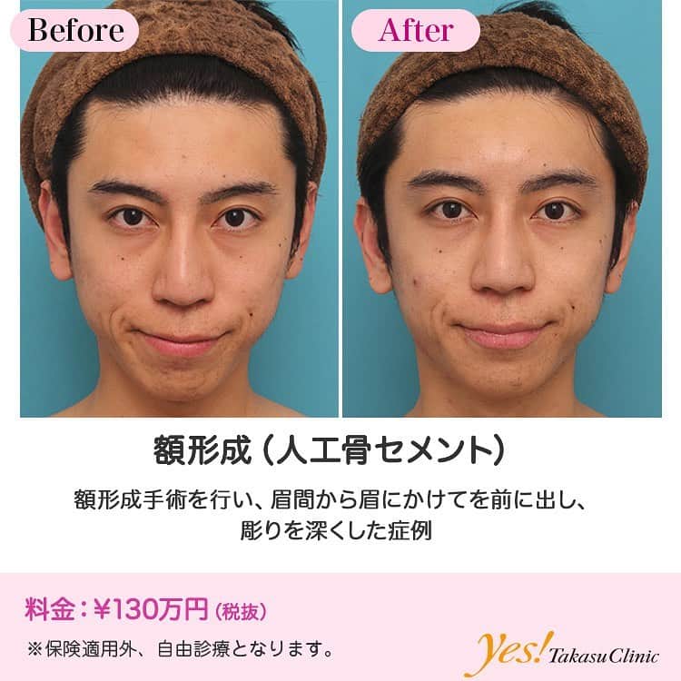 高須クリニックのインスタグラム：「👨🏻‍⚕️高須幹弥医師からのコメント✨⠀ 20代男性の患者様で、額を出して彫りを深くしたいというご要望でした。 診察させていただいたところ、程よく眉間~眉の部分の骨は前方に出ていて、額全体も前方に程よく出ているため、適度に彫りの深さはありました。 寧ろ、日本人の平均よりもやや彫りの深さがあるくらいでしたが、患者様のご要望で更に彫りを深くすることになりました。 額を出して彫りを深くする場合、眉間~眉の部分に額専用のヒアルロン酸を注入して前方に出す方法と、手術で人工骨セメント（ハイドロキシアパタイト）を前頭骨にペーストして前方に出す方法がありますが、患者様は永久的な効果がある人工骨セメント手術を選択されました。 手術は、両側冠状切開下に前頭骨を露出させ、眼窩上縁の部分に人工骨セメントを6ccペーストし、眉間~眉の部分が前方に突出するようにしました。 手術後は程よく自然な範囲内で彫りが深い顔になりました。 男らしさが増し、ハーフっぽい印象にもなりました。 ---------------------------------------------------- 🌈料金✨⠀ ●額形成（人工骨セメント） 骨セメント ¥1,300,000【名古屋、大阪】 ---------------------------------------------------- ⚠️リスク・副作用・合併症✨⠀ ●額形成（人工骨セメント） 腫れ（術後） 仕上がりのわずかな左右差（完璧なシンメトリーは不可） 仕上がりが完璧に自分の理想の形にならないことがある 感染 髪の毛が薄くなる可能性 感覚が鈍くなる、部分的になくなる可能性 --------------------------------------------------- 😊施術についての詳細✨⠀⠀ https://www.takasu.co.jp/photo/hitaicement003.html ---------------------------------------------------- 📞ご予約・お問い合わせ✨⠀ 0120-5587-10⠀ https://www.takasu.co.jp/cgi-bin/form/contact.cgi ※症例写真や施術に関するご質問なども上記までお願い致します。 ---------------------------------------------------- #額形成 #人工骨セメント #額形成手術 #彫りを深くしたい #額を出したい  #皮膚 #美容 #美肌 #エイジングケア #美容整形 #美容外科 #美容クリニック #美容好き #美容皮膚科 #モニター #モニター募集 #高須クリニック #高須クリニック名古屋 #高須幹弥 #整形したい #プチ整形 #症例 #症例写真 #可愛くなりたい #可愛い #美人」