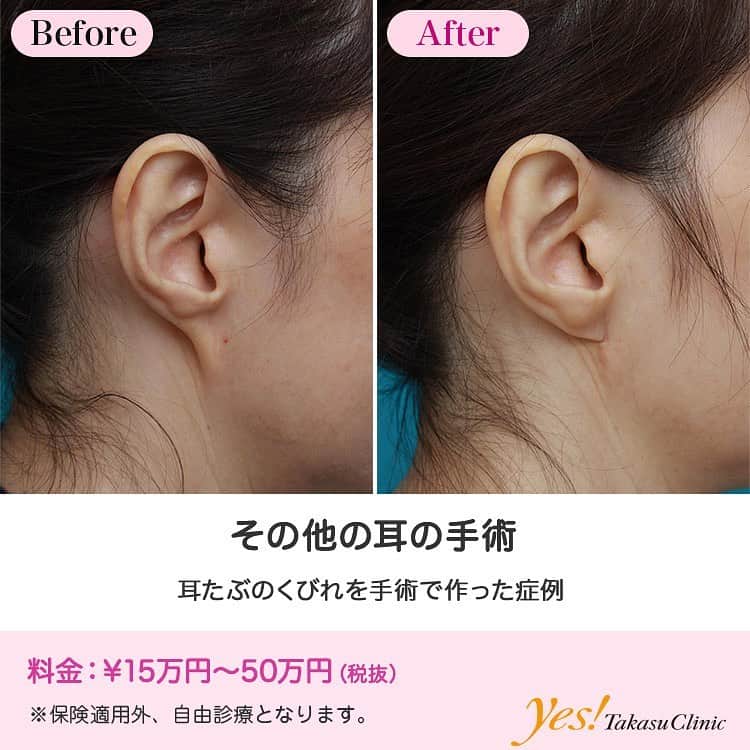 高須クリニックのインスタグラム：「👨🏻‍⚕️高須幹弥医師からのコメント✨⠀ 30代女性の患者様で、生まれつき耳たぶが引っ張られたように下に伸びて、くびれがないのがお悩みでした。 手術は局所麻酔下にZ法で耳たぶの付け根を作る部分で皮膚を入れ換え、傷を縫合しました。 術後は耳たぶの付け根に程よいくびれができました。 耳たぶの付け根の下に傷が残りますが、時間と共に目立たなくなっていきます。 この方は生まれつきのタイプでしたが、稚拙なフェイスリフト手術を受けた後に、この方と同じように耳たぶが引っ張られたように下に伸びてしまう人もいます。 そのような人に対しては、まだたるみがある人にもう一度フェイスリフトを行うか、この症例と同じようにZ法などを行うことによって、耳たぶのくびれを作ることができます。 ---------------------------------------------------- 🌈料金✨⠀ ●その他の耳の手術 片側 ¥150,000~500,000【東京、横浜、名古屋、大阪】 ---------------------------------------------------- ⚠️リスク・副作用・合併症✨⠀ ●その他の耳の手術 手術後に処方する抗生剤や痛みどめによるアレルギー症状 仕上がりのわずかな左右差（完璧なシンメトリーは不可） --------------------------------------------------- 😊施術についての詳細✨⠀⠀ https://www.takasu.co.jp/photo/mimiother08.html ---------------------------------------------------- 📞ご予約・お問い合わせ✨⠀ 0120-5587-10⠀ https://www.takasu.co.jp/cgi-bin/form/contact.cgi ※症例写真や施術に関するご質問なども上記までお願い致します。 ---------------------------------------------------- #耳の手術 #その他の耳の手術 #耳たぶのくびれ #耳たぶのくびれを作る #耳たぶの手術 #耳整形 #皮膚 #美容 #美肌 #エイジングケア #美容整形 #美容外科 #美容クリニック #美容好き #美容皮膚科 #モニター #モニター募集 #高須クリニック #高須クリニック名古屋 #高須幹弥 #整形したい #プチ整形 #症例 #症例写真 #可愛くなりたい #可愛い #美人」