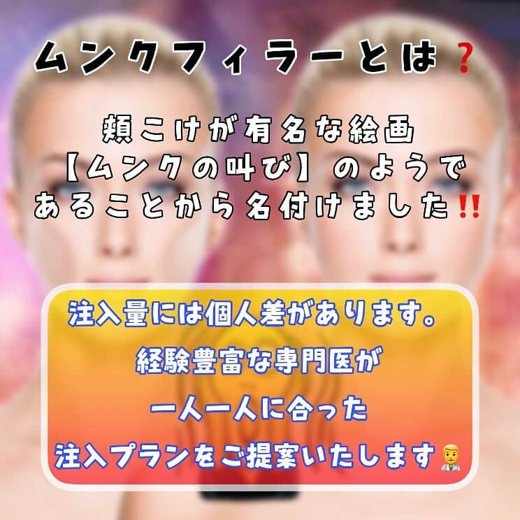 恵比寿フィラークリニックさんのインスタグラム写真 - (恵比寿フィラークリニックInstagram)「﻿ ムンクの叫びのようになってない？？😱﻿ 【ムンクフィラー】で改善！！﻿ ﻿ 頬のこけが有名な絵画"ムンクの叫び"のようであることから名付けました😆﻿ 実は年齢関係なくお悩みが多い『頬こけ』、、、﻿ ヒアルロン酸を注入することでふっくら若々しく女性らしく❣﻿ さらにハリが出てリフトアップ効果もあるんです💡﻿ ﻿ 📌ムンクフィラー ﻿ 0.1cc 3,300円(税抜き)～﻿ ※注入量には個人差があります。﻿ 経験豊富な専門医が1人1人に合った注入プランをご提案いたします✨﻿ カウンセリングにてお気軽にご相談ください😘﻿ ﻿ ﻿ ﻿ ﻿ #フィラークリニック #フィラー #プチ整形 #美容整形 #filler #ヒアルロン酸 #ボトックス #水光注射 #糸リフト #唇 #lip #鼻 #鼻筋 #鼻整形 #涙袋 #顎 #ほうれい線 #ほうれい線改善 #エイジング #エイジングケア #アンチエイジング #リフトアップ効果 #リフトアップ #若見え #老け顔 #げっそり #頬ツヤぷるん #頬肉 #頬こけ #ムンクフィラー」11月26日 16時12分 - filler_clinic