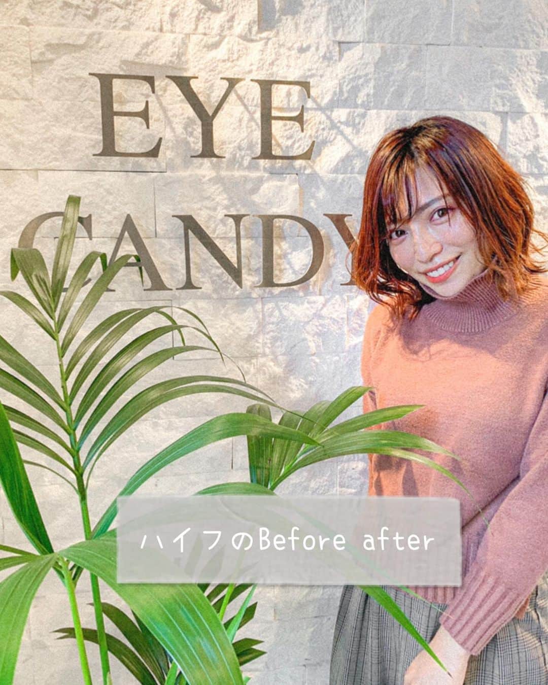 和希詩織のインスタグラム：「美容ハイフのBefore  after📸半顔検証。 . . . 美容dayメンテナンス🙆‍♀️✨ @eyecandy_omotesando で医療機器の最新メーカーの美容ハイフ ウルトラVハイフしてきた✌️ . . Beforeとafter載せたから 他の写真も見てね👉👉👉📸 . . . 頬山が上がって#リフトアップ したよ！ 頬山が上がると法令線が薄くなっていくからめちゃ嬉しい😆 . . . ちなみに痛みは全然ない🙆‍♀️ 脱毛の痛くないやつくらい！ 少し痛みを感じやすいのは頬骨とかかな？でもほんのりだよ✌️ . . . . ココのハイフは まぶたの上もハイフ打ってくれるからまぶたのたるみが気になる人にもオススメ🙆‍♀️ . . 医療ハイフより通いやすい価格で 医療ハイフの1/3のパワーみたいだよ！ わかりやすい効果のパワーで言うと 医療脱毛と美容脱毛みたいな感じかな！ . . . 本格ハイフが 初回が４４００円で施術可能 2回目以降も9900円で通うことができるサロンだよ🙆‍♀️ . . . 動画も撮ったからYouTubeチャンネルに載せるね🙆‍♀️❤️ プロフィールのURLから👇 #YouTube の#チャンネル登録お願いします 🙇‍♀️ . . . . . . @eyecandyhifu #eyecandyhifu#eyecandy #ウルトラVハイフ#ハイフ #HIFU #小顔 #リフトアップ #フェイシャル #エステ #美容　#たるみ改善 #小顔効果 #たるみ#アンチエイジング#医療」