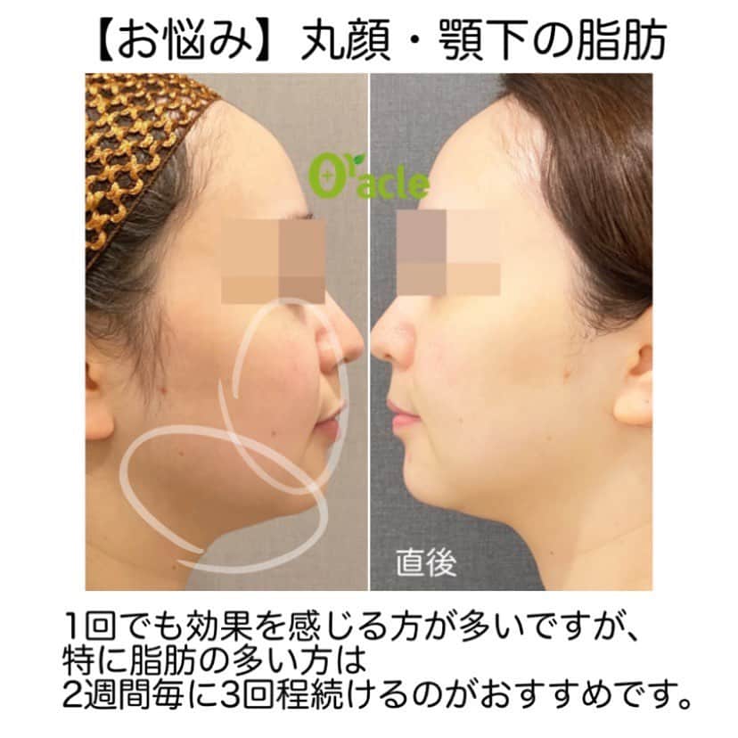 オラクル美容皮膚科東京新宿院さんのインスタグラム写真 - (オラクル美容皮膚科東京新宿院Instagram)「#ハイフ　＋　#脂肪溶解　 【名古屋限定メニュー﻿】 ウルトラセルQプラスリニア トライアル実施中‼️﻿ ﻿ ハイフのウルトラセルＱ＋にリニア（脂肪溶解）モード追加‼️ ウルトラセルＱ＋の新型リニアは「脂肪溶解」を目的として、特に頬から下の部分を施術します。﻿ ﻿ ✅丸顔が気になる方﻿ ✅フェイスラインのもたつき﻿ ✅二重顎﻿ ﻿ などの効果が期待できる治療です。 ﻿ 直後から効果を実感できますが、徐々に脂肪が排出されます。﻿  脂肪が多めで顔痩せしたい‼️ という方は2週間に一度の施術も可能です。﻿ 回数はドクターとご相談ください😊﻿ ﻿ さらに…ハイフと組み合わせることで、より小顔引締め効果が期待できます。﻿ ﻿ 導入トライアル実施中‼️﻿ 🉐リニア400shot ﻿ 45,000円（税抜）※通常　50,000円﻿ ﻿ 🉐リニア400shot ＋ハイフ400shot ﻿ 135,000円（税抜）※通常150,000円﻿ ﻿ リニアは名古屋のみとなります。﻿ ﻿ ハイフは新宿院で施術可能です。 ※ハイフは11月30%オフになっております﻿ ﻿ お問い合わせお待ちしております🙇‍♀️﻿ ﻿ ﻿ ▪️▫️▪️▫️▪️▫️▪️▫️▪️▫️﻿ ﻿ 🇯🇵オラクル美容皮膚科🇰🇷﻿ 📍東京新宿院﻿ 新宿3丁目19-4 MLJ新宿8階﻿ ﻿ 📍名古屋院﻿ 名古屋市中区錦3丁目24-4﻿ サンシャイン栄5階﻿ ﻿ 【専門】﻿ ニキビ（跡）／毛穴／シミ／しわ／たるみ／痩身／アンチエイジング／美白美肌治療全般／ブライダル相談／メンズ美容﻿ ﻿ 🗝完全予約制﻿ 👠土日祝日も診療﻿ ﻿ 【予約方法】﻿ ☎0120-905-696﻿ ⏰9:00～21:00［年中無休］﻿ ﻿ LINE、メール24時間📧﻿ LINE🆔 @oracle.jp ﻿ 📩HPメールフォームよりお願いいたします﻿ ﻿ ﻿ ▪️▫️▪️▫️▪️▫️▪️▫️▪️▫️﻿ ﻿ #オラクル美容皮膚科 ﻿ #oracle #韓国美容 #美容皮膚科 ﻿ #皮膚科 #美容 #小顔矯正 #コラーゲン #美容オタク #美容マニア  #弾力 #ハリ　#일본피부과 #오라클피부과 #リフトアップ #シワ #美肌  #肌管理 #韓国美容皮膚科 #乾燥  #パック #弾力管理 #小顔　　#顔痩せ　#リニア﻿ #ウルトラセルQプラス　#ハイフ﻿」11月27日 9時49分 - oraclejp