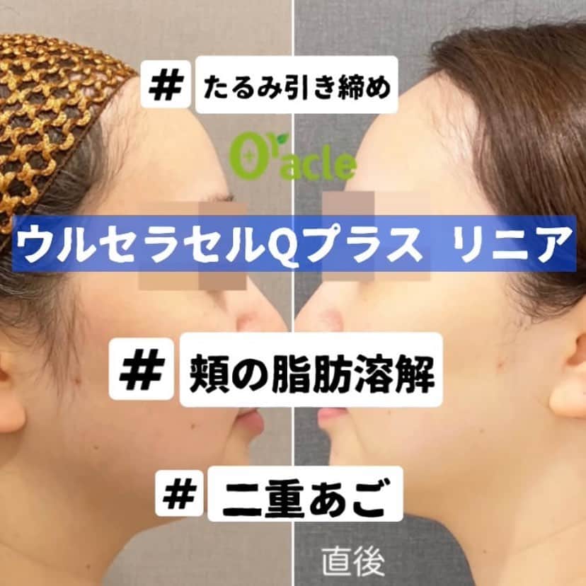 オラクル美容皮膚科東京新宿院さんのインスタグラム写真 - (オラクル美容皮膚科東京新宿院Instagram)「#ハイフ　＋　#脂肪溶解　 【名古屋限定メニュー﻿】 ウルトラセルQプラスリニア トライアル実施中‼️﻿ ﻿ ハイフのウルトラセルＱ＋にリニア（脂肪溶解）モード追加‼️ ウルトラセルＱ＋の新型リニアは「脂肪溶解」を目的として、特に頬から下の部分を施術します。﻿ ﻿ ✅丸顔が気になる方﻿ ✅フェイスラインのもたつき﻿ ✅二重顎﻿ ﻿ などの効果が期待できる治療です。 ﻿ 直後から効果を実感できますが、徐々に脂肪が排出されます。﻿  脂肪が多めで顔痩せしたい‼️ という方は2週間に一度の施術も可能です。﻿ 回数はドクターとご相談ください😊﻿ ﻿ さらに…ハイフと組み合わせることで、より小顔引締め効果が期待できます。﻿ ﻿ 導入トライアル実施中‼️﻿ 🉐リニア400shot ﻿ 45,000円（税抜）※通常　50,000円﻿ ﻿ 🉐リニア400shot ＋ハイフ400shot ﻿ 135,000円（税抜）※通常150,000円﻿ ﻿ リニアは名古屋のみとなります。﻿ ﻿ ハイフは新宿院で施術可能です。 ※ハイフは11月30%オフになっております﻿ ﻿ お問い合わせお待ちしております🙇‍♀️﻿ ﻿ ﻿ ▪️▫️▪️▫️▪️▫️▪️▫️▪️▫️﻿ ﻿ 🇯🇵オラクル美容皮膚科🇰🇷﻿ 📍東京新宿院﻿ 新宿3丁目19-4 MLJ新宿8階﻿ ﻿ 📍名古屋院﻿ 名古屋市中区錦3丁目24-4﻿ サンシャイン栄5階﻿ ﻿ 【専門】﻿ ニキビ（跡）／毛穴／シミ／しわ／たるみ／痩身／アンチエイジング／美白美肌治療全般／ブライダル相談／メンズ美容﻿ ﻿ 🗝完全予約制﻿ 👠土日祝日も診療﻿ ﻿ 【予約方法】﻿ ☎0120-905-696﻿ ⏰9:00～21:00［年中無休］﻿ ﻿ LINE、メール24時間📧﻿ LINE🆔 @oracle.jp ﻿ 📩HPメールフォームよりお願いいたします﻿ ﻿ ﻿ ▪️▫️▪️▫️▪️▫️▪️▫️▪️▫️﻿ ﻿ #オラクル美容皮膚科 ﻿ #oracle #韓国美容 #美容皮膚科 ﻿ #皮膚科 #美容 #小顔矯正 #コラーゲン #美容オタク #美容マニア  #弾力 #ハリ　#일본피부과 #오라클피부과 #リフトアップ #シワ #美肌  #肌管理 #韓国美容皮膚科 #乾燥  #パック #弾力管理 #小顔　　#顔痩せ　#リニア﻿ #ウルトラセルQプラス　#ハイフ﻿」11月27日 9時49分 - oraclejp
