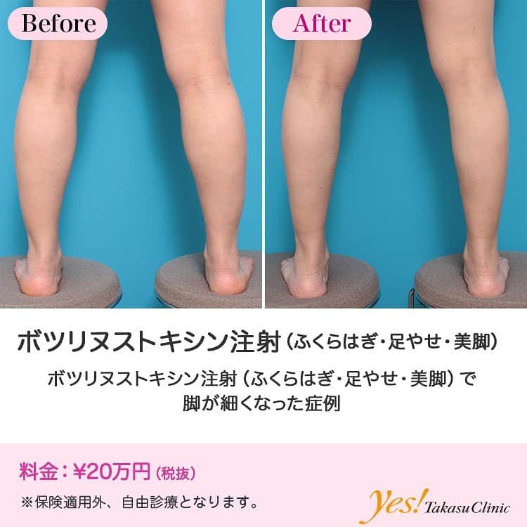 高須クリニックのインスタグラム：「👨🏻‍⚕️高須幹弥医師からのコメント✨⠀ 30代女性の患者様で、ふくらはぎを細くしたいというご要望でした。 診察させていただいたところ、皮下脂肪はほとんどついておらず、日本人女性の平均サイズくらいの太さのふくらはぎでした。 しかし、患者様は、「私のふくらはぎは太いので、モデルさんのようなもっともっと細いふくらはぎになりたいんです。」と仰っていたため、ふくらはぎにボツリヌストキシン注射をして筋肉（腓腹筋、ヒラメ筋）を細くすることになりました。 注射後2ヶ月には、ふくらはぎの筋肉が細くなり、全体的に一回り細くなりました。 モデルさんやK-POPアイドルなどを見ると、平均サイズよりもはるかに細いふくらはぎの人が多いです。 この患者様のように、体全体が痩せていて、皮下脂肪もついていない人のふくらはぎを、モデルさんのように更に細くする場合は、脂肪吸引やイタリアン・メソシェイプ（イタリアンメソセラピー）・脂肪溶解注射は適応にならないため、ボツリヌストキシン注射が適応になることが多いです。 ---------------------------------------------------- 🌈料金✨⠀ ●ボツリヌストキシン注射（ふくらはぎ・足やせ・美脚） ¥200,000【全院】 ---------------------------------------------------- ⚠️リスク・副作用・合併症✨⠀ ●ボツリヌストキシン注射（ふくらはぎ・足やせ・美脚） 内出血（注射針が血管に当たってしまった場合） 妊活・妊娠・授乳中の方への施術不可 わずかに筋力が弱くなる --------------------------------------------------- 😊施術についての詳細✨⠀⠀ https://www.takasu.co.jp/photo/leg11.html ---------------------------------------------------- 📞ご予約・お問い合わせ✨⠀ 0120-5587-10⠀ https://www.takasu.co.jp/cgi-bin/form/contact.cgi ※症例写真や施術に関するご質問なども上記までお願い致します。 ---------------------------------------------------- #ボツリヌストキシン注射 #ふくらはぎ #足やせ #美脚 #ふくらはぎを細くしたい #皮膚 #美容 #美肌 #エイジングケア #美容整形 #美容外科 #美容クリニック #美容好き #美容皮膚科 #モニター #モニター募集 #高須クリニック #高須クリニック名古屋 #高須幹弥 #整形したい #プチ整形 #症例 #症例写真 #可愛くなりたい #可愛い #美人」