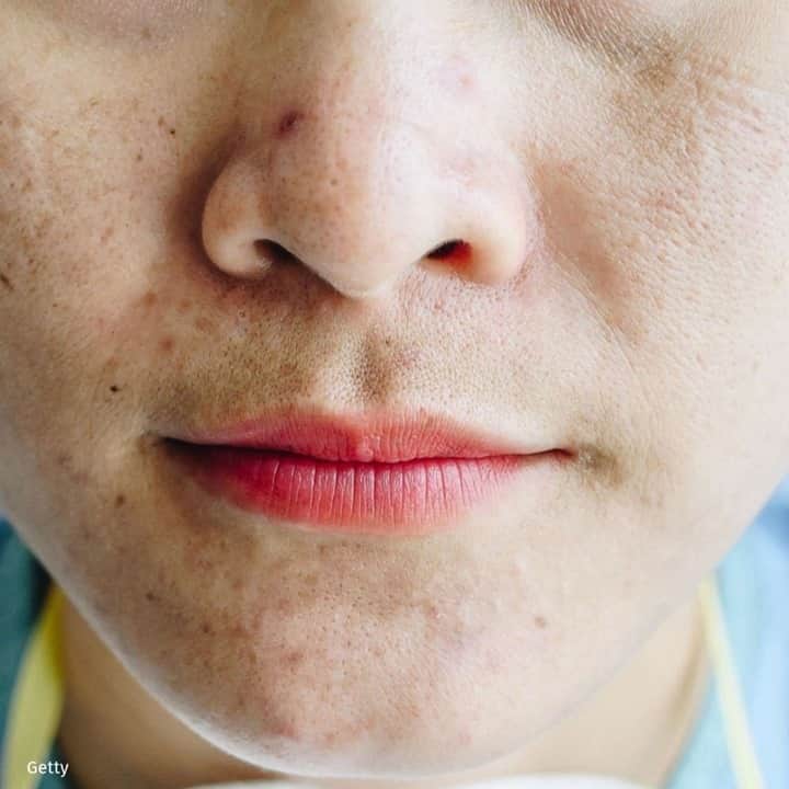 Good Morning Americaさんのインスタグラム写真 - (Good Morning AmericaInstagram)「Struggling with #maskne? LINK IN BIO for how dermatologists say to treat and prevent it.」12月3日 12時01分 - goodmorningamerica
