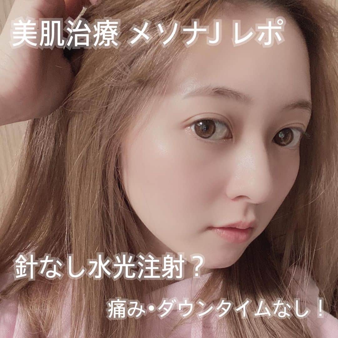 末次愛梨のインスタグラム：「@omotesando_medical_clinic 六本木院で12月から導入するってきいて気になってたメソナJやってきた〜♡♡  美容成分を真皮まで導入してくれるんだって🔥  まずポイントは全く痛くないしダウンタイムがないから嬉しい😭 美を手に入れるには痛みは付き物っていうけど、痛みはまじで嫌だ😂(ビビり)  ちなみにこのメソナJはどんな人へオススメなのかというと…  ☑乾燥肌 ☑肌荒れ ☑ニキビやニキビ跡 ☑毛穴やシミ ☑赤ら顔や肝斑  ほぼ当てはまる私にとっては神治療😇✨  しかも効果が施術後すぐ実感できて、 肌もっちもちになって 肌の色がトーンアップしてびっくり😳 唇までぷるぷるになったよ😂💗  濃かったニキビ跡も薄くなったから 回数重ねていったらもっと効果期待できそう♪  これはハマるわ🥺🔥🔥  #メソナj#美容レポ#針なし水光注射#美容#美肌治療#美肌#美肌ケア#表参道メディカルクリニック六本木院#表参道メディカルクリニック#ニキビ跡#ニキビ#ゼオスキン#水光肌#水光注射」