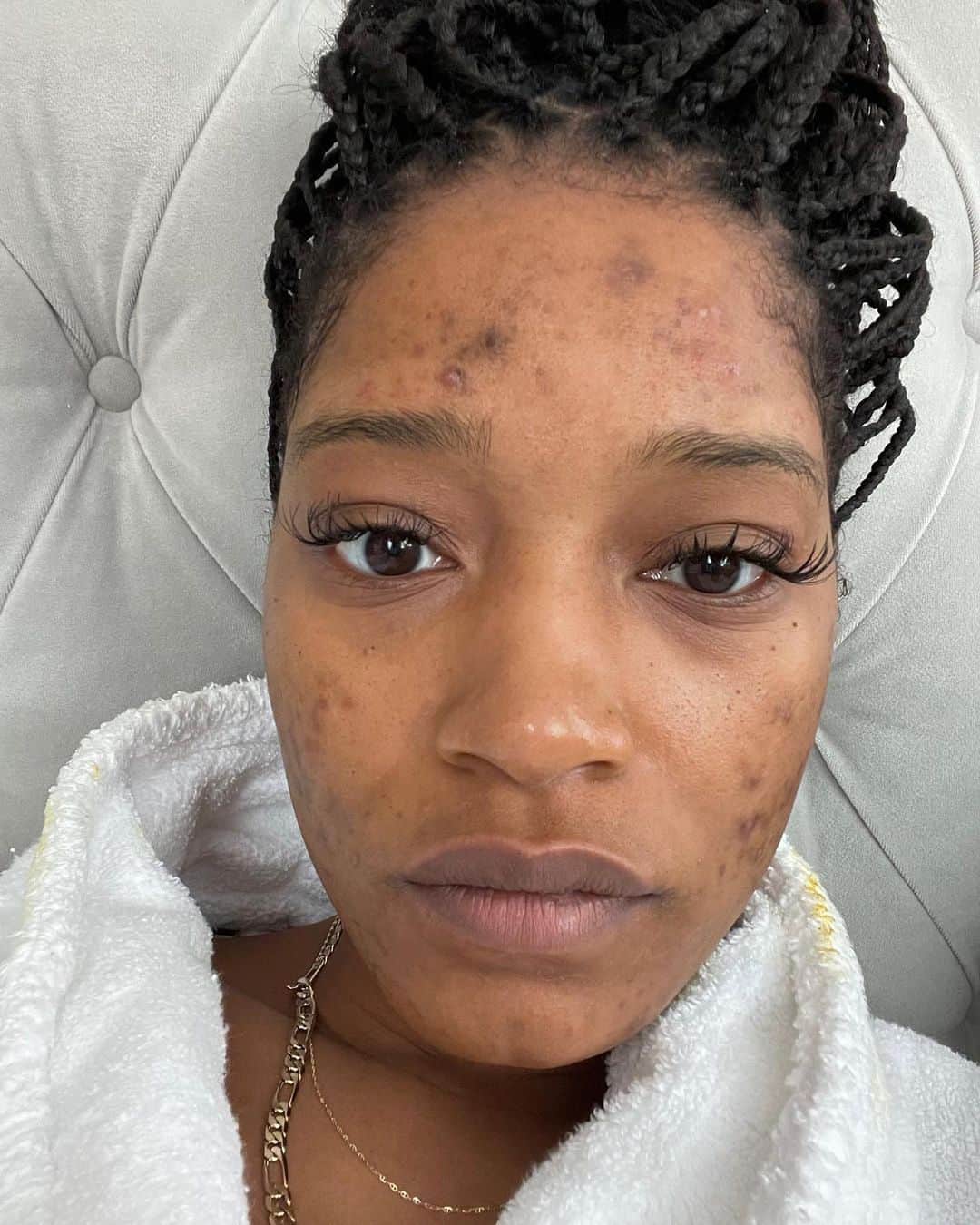 Teen Vogueさんのインスタグラム写真 - (Teen VogueInstagram)「"To all the people struggling with this please know you’re not alone and that you are still so f**king fine!" 🥰 At the link in bio, Keke Palmer opens up about her acne journey and #PCOS diagnosis.」12月5日 4時50分 - teenvogue