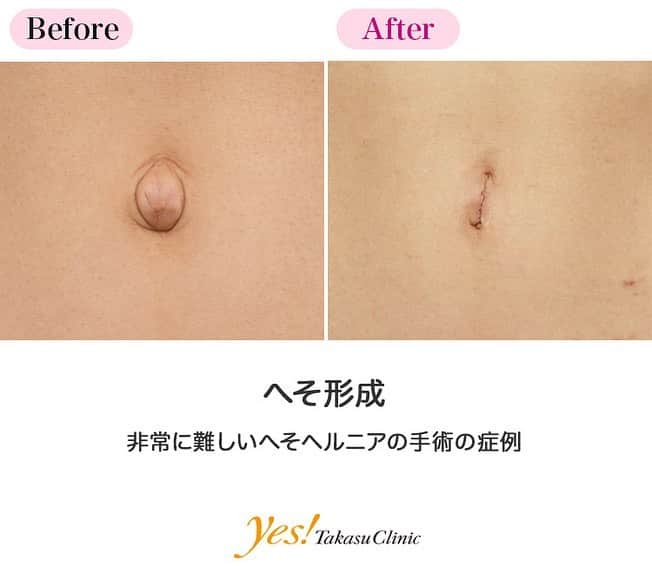 高須クリニックのインスタグラム：「👨🏻‍⚕️高須幹弥医師からのコメント✨⠀ 10代後半の女性患者様で、出べそで悩んでいらっしゃいました。 触診したところ、へその奥に小さな穴が開いていて、へそとお腹の中が交通していました。 出べその膨らみの中には腹水（お腹の中を流れている水）が貯まっており、臍ヘルニアの状態でした。 手術は局所麻酔下に余っている皮膚を切除して、ヘルニア門（お腹の中と交通している穴）を縫合して閉鎖し、皮膚を縫合しました。 この方は元々へその窪みがほとんどないので、術後にへその窪みを深く作ることはできませんでしたが、術前に比べるとかなりすっきりしたへそにすることができました。 ---------------------------------------------------- 🌈料金✨⠀ ●へそ形成 単純に出ベソを切除縫縮する場合 ¥150,000 / ヘソヘルニアや複雑な手術になる場合 ¥200,000~300,000【東京、横浜、名古屋、大阪】 ---------------------------------------------------- ⚠️リスク・副作用・合併症✨⠀ ●へそ形成 手術後に処方する抗生剤や痛みどめによるアレルギー症状 仕上がりのわずかな左右差（完璧なシンメトリーは不可） 仕上がりが完璧に自分の理想の形にならないことがある 傷跡が肥厚性瘢痕やケロイドになる可能性 --------------------------------------------------- 😊施術についての詳細✨⠀⠀ https://www.takasu.co.jp/photo/navel_11.html ---------------------------------------------------- 📞ご予約・お問い合わせ✨⠀ 0120-5587-10⠀ https://www.takasu.co.jp/cgi-bin/form/contact.cgi ※症例写真や施術に関するご質問なども上記までお願い致します。 ---------------------------------------------------- #へそ形成 #でべそ #でべその修正 #でべその修正手術 #でべそを治したい #へそヘルニア #皮膚 #美容 #美肌 #エイジングケア #美容整形 #美容外科 #美容クリニック #美容好き #美容皮膚科 #モニター #モニター募集 #高須クリニック #高須クリニック名古屋 #高須幹弥 #整形したい #プチ整形 #症例 #症例写真 #可愛くなりたい #可愛い #美人」